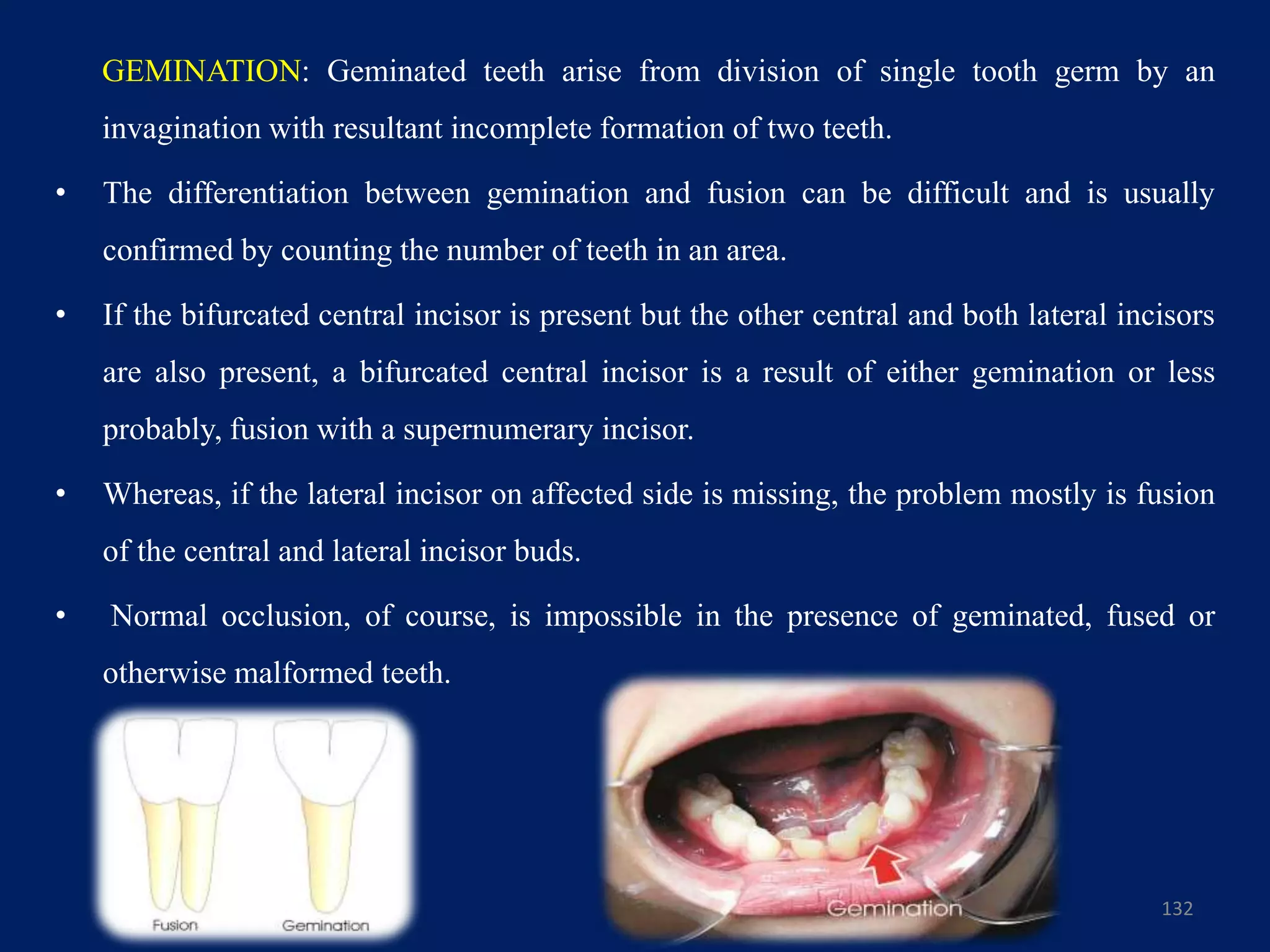 132
GEMINATION: Geminated teeth arise from division of single tooth germ by an
invagination with resultant incomplete formation of two teeth.
• The differentiation between gemination and fusion can be difficult and is usually
confirmed by counting the number of teeth in an area.
• If the bifurcated central incisor is present but the other central and both lateral incisors
are also present, a bifurcated central incisor is a result of either gemination or less
probably, fusion with a supernumerary incisor.
• Whereas, if the lateral incisor on affected side is missing, the problem mostly is fusion
of the central and lateral incisor buds.
• Normal occlusion, of course, is impossible in the presence of geminated, fused or
otherwise malformed teeth.
 