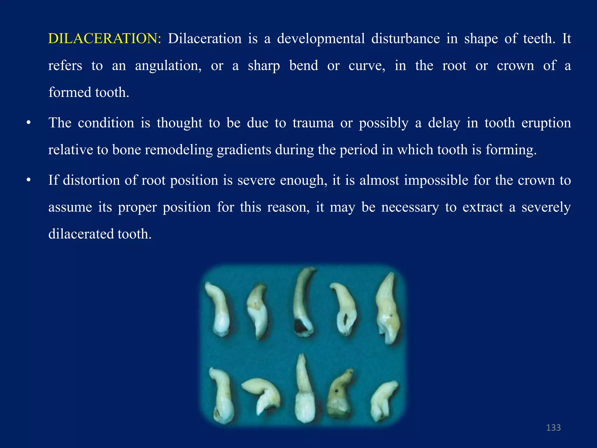133
DILACERATION: Dilaceration is a developmental disturbance in shape of teeth. It
refers to an angulation, or a sharp bend or curve, in the root or crown of a
formed tooth.
• The condition is thought to be due to trauma or possibly a delay in tooth eruption
relative to bone remodeling gradients during the period in which tooth is forming.
• If distortion of root position is severe enough, it is almost impossible for the crown to
assume its proper position for this reason, it may be necessary to extract a severely
dilacerated tooth.
 