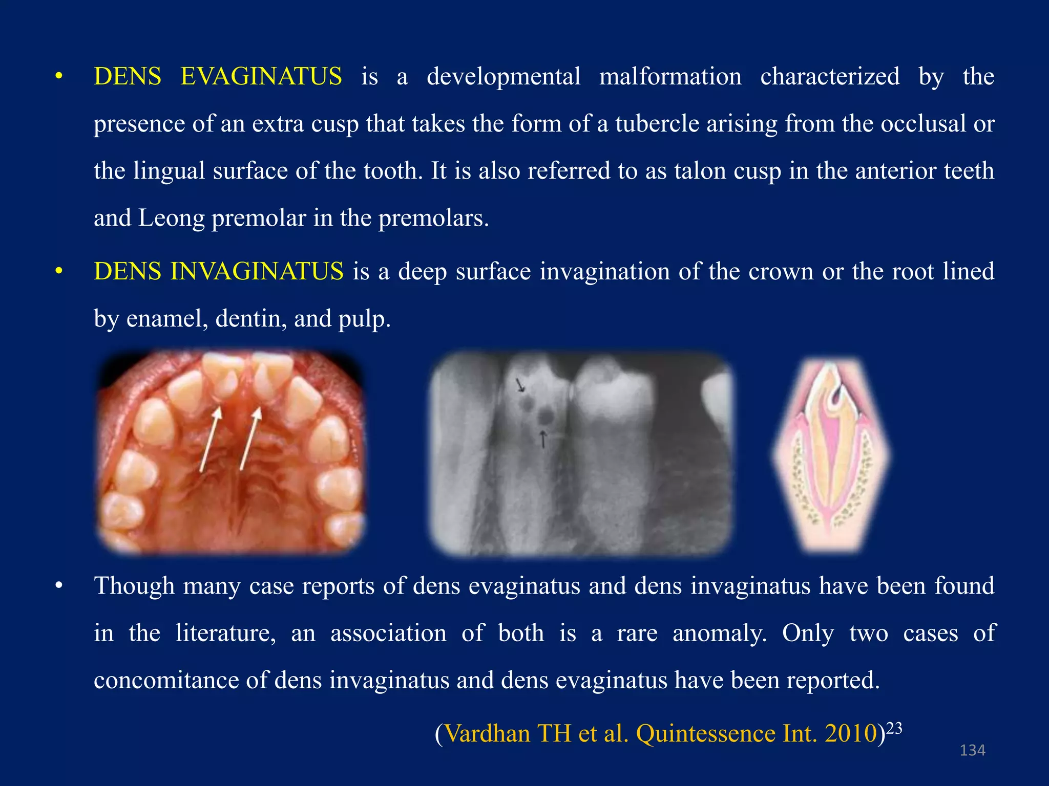 • DENS EVAGINATUS is a developmental malformation characterized by the
presence of an extra cusp that takes the form of a tubercle arising from the occlusal or
the lingual surface of the tooth. It is also referred to as talon cusp in the anterior teeth
and Leong premolar in the premolars.
• DENS INVAGINATUS is a deep surface invagination of the crown or the root lined
by enamel, dentin, and pulp.
• Though many case reports of dens evaginatus and dens invaginatus have been found
in the literature, an association of both is a rare anomaly. Only two cases of
concomitance of dens invaginatus and dens evaginatus have been reported.
(Vardhan TH et al. Quintessence Int. 2010)23
134
 