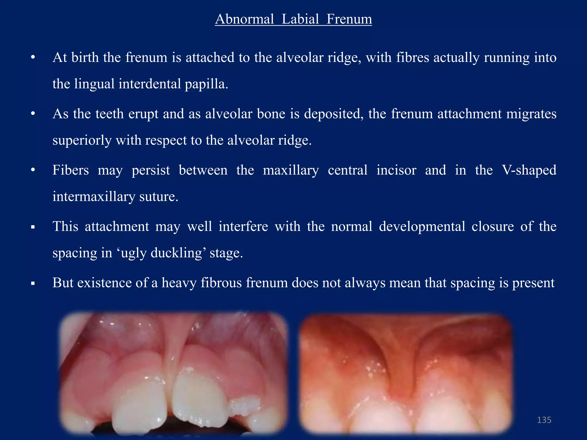 Abnormal Labial Frenum
• At birth the frenum is attached to the alveolar ridge, with fibres actually running into
the lingual interdental papilla.
• As the teeth erupt and as alveolar bone is deposited, the frenum attachment migrates
superiorly with respect to the alveolar ridge.
• Fibers may persist between the maxillary central incisor and in the V-shaped
intermaxillary suture.
 This attachment may well interfere with the normal developmental closure of the
spacing in ‘ugly duckling’ stage.
 But existence of a heavy fibrous frenum does not always mean that spacing is present
135
 