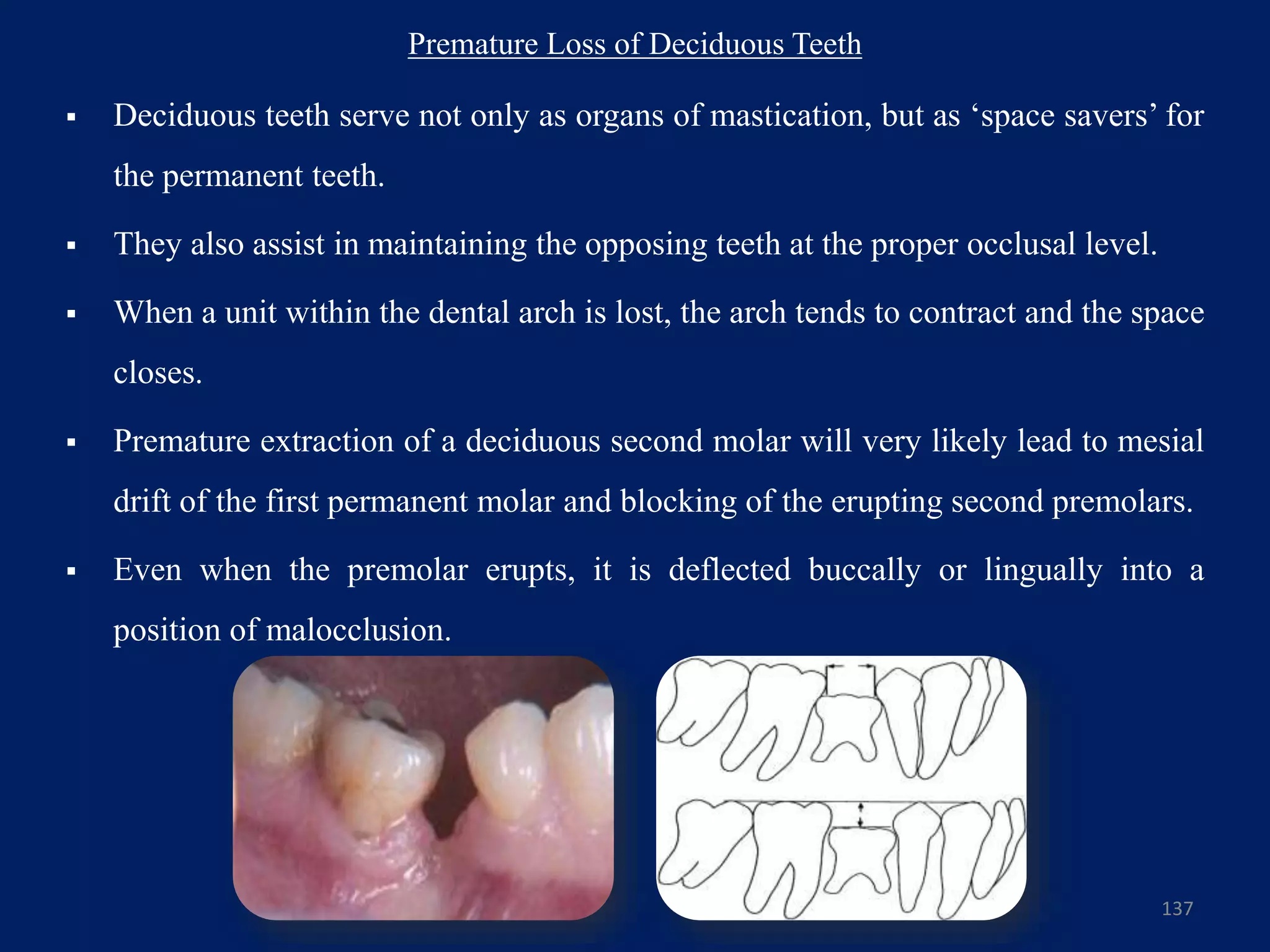 Premature Loss of Deciduous Teeth
 Deciduous teeth serve not only as organs of mastication, but as ‘space savers’ for
the permanent teeth.
 They also assist in maintaining the opposing teeth at the proper occlusal level.
 When a unit within the dental arch is lost, the arch tends to contract and the space
closes.
 Premature extraction of a deciduous second molar will very likely lead to mesial
drift of the first permanent molar and blocking of the erupting second premolars.
 Even when the premolar erupts, it is deflected buccally or lingually into a
position of malocclusion.
137
 