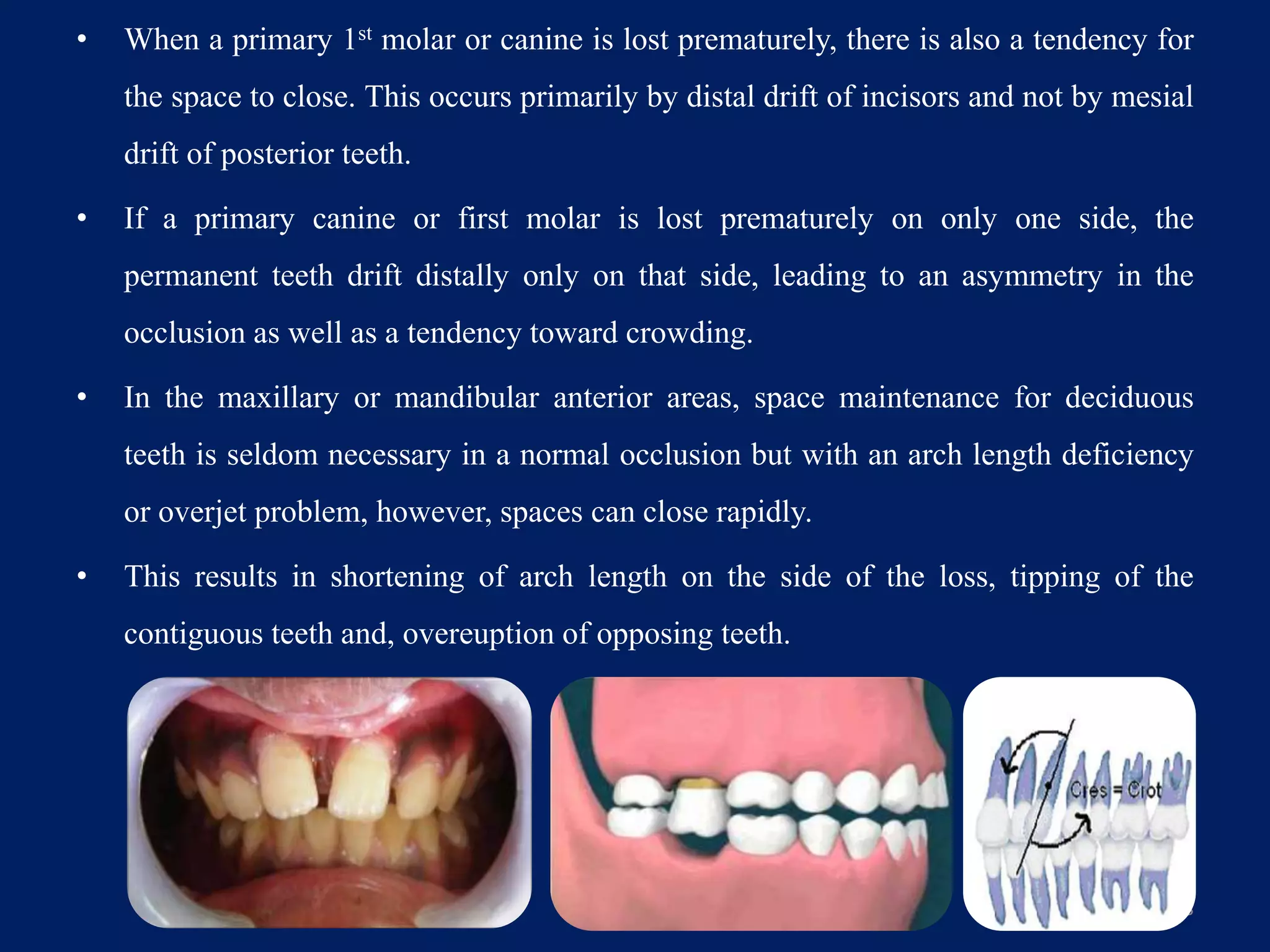 • When a primary 1st molar or canine is lost prematurely, there is also a tendency for
the space to close. This occurs primarily by distal drift of incisors and not by mesial
drift of posterior teeth.
• If a primary canine or first molar is lost prematurely on only one side, the
permanent teeth drift distally only on that side, leading to an asymmetry in the
occlusion as well as a tendency toward crowding.
• In the maxillary or mandibular anterior areas, space maintenance for deciduous
teeth is seldom necessary in a normal occlusion but with an arch length deficiency
or overjet problem, however, spaces can close rapidly.
• This results in shortening of arch length on the side of the loss, tipping of the
contiguous teeth and, overeuption of opposing teeth.
138
 