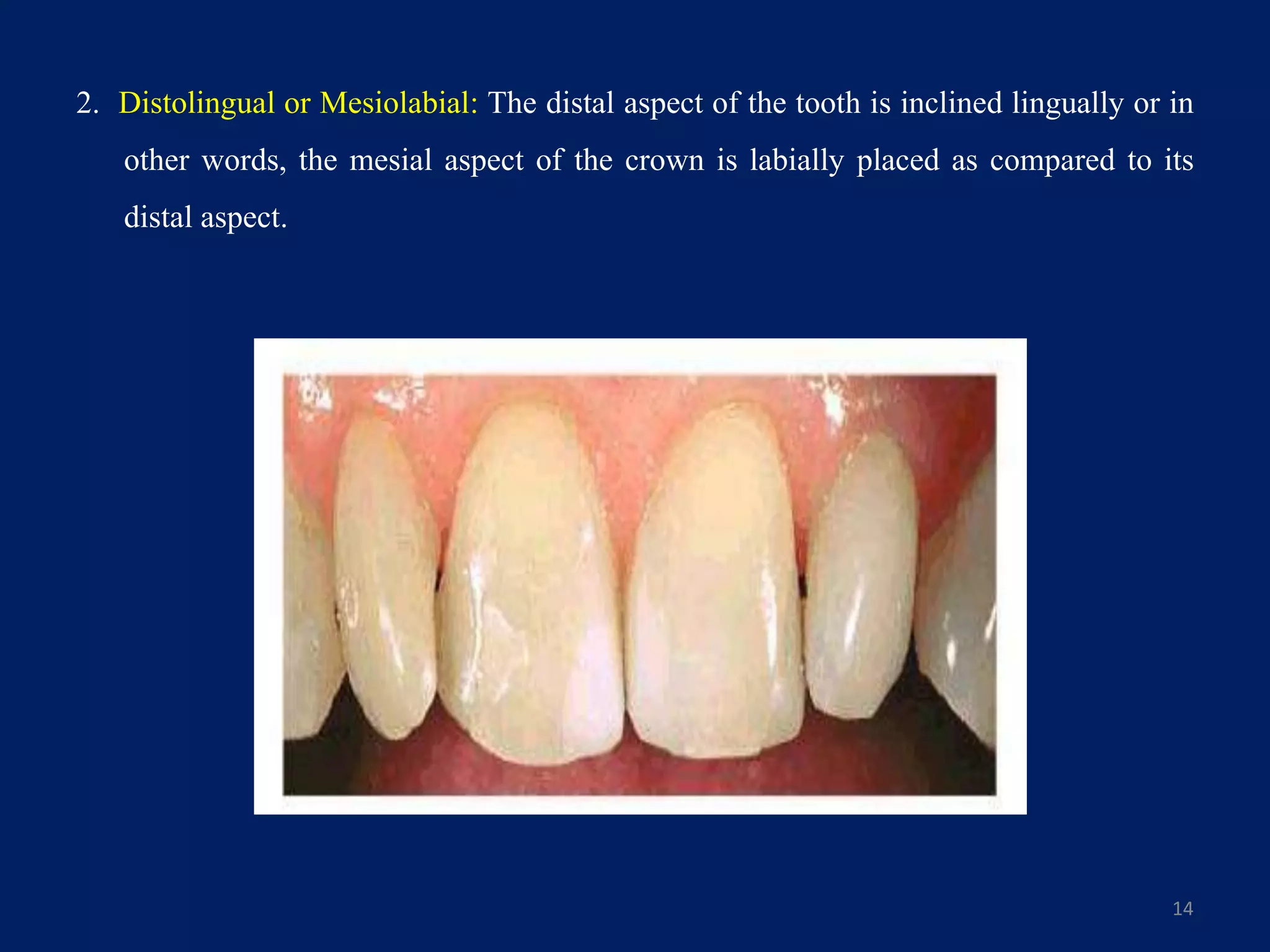 2. Distolingual or Mesiolabial: The distal aspect of the tooth is inclined lingually or in
other words, the mesial aspect of the crown is labially placed as compared to its
distal aspect.
14
 