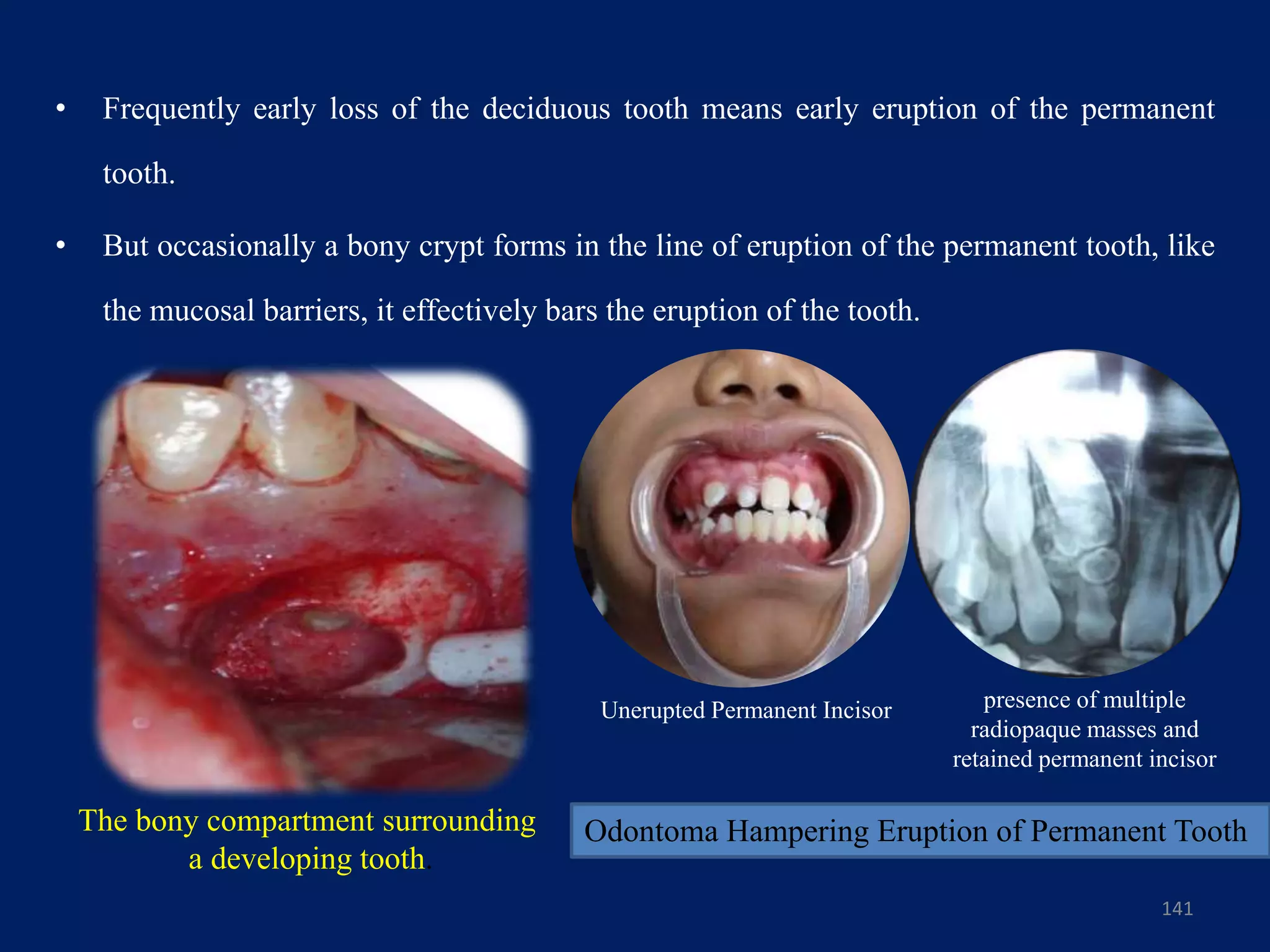 • Frequently early loss of the deciduous tooth means early eruption of the permanent
tooth.
• But occasionally a bony crypt forms in the line of eruption of the permanent tooth, like
the mucosal barriers, it effectively bars the eruption of the tooth.
141
The bony compartment surrounding
a developing tooth.
Unerupted Permanent Incisor presence of multiple
radiopaque masses and
retained permanent incisor
Odontoma Hampering Eruption of Permanent Tooth
 