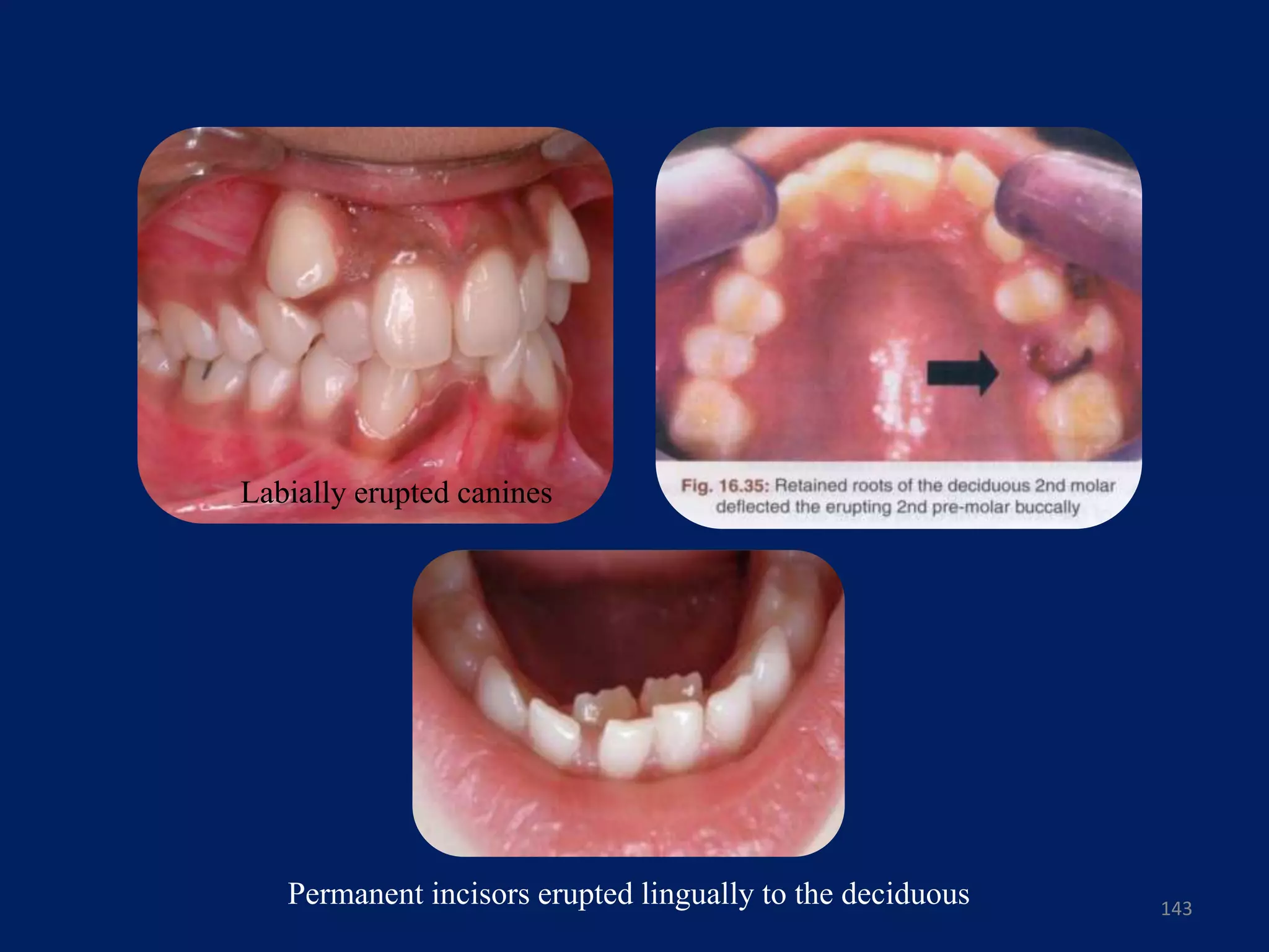 143
Labially erupted canines
Permanent incisors erupted lingually to the deciduous
 