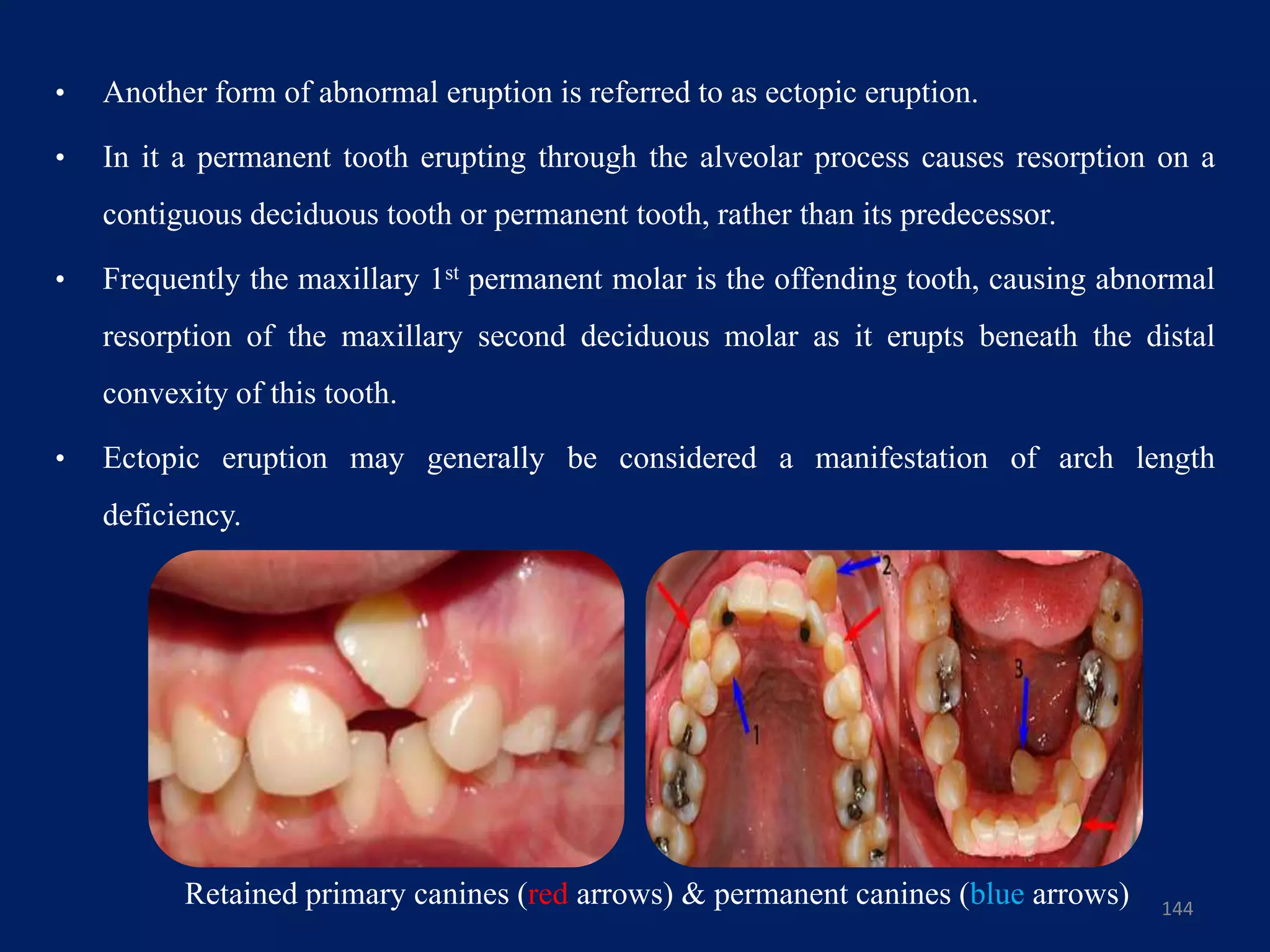 • Another form of abnormal eruption is referred to as ectopic eruption.
• In it a permanent tooth erupting through the alveolar process causes resorption on a
contiguous deciduous tooth or permanent tooth, rather than its predecessor.
• Frequently the maxillary 1st permanent molar is the offending tooth, causing abnormal
resorption of the maxillary second deciduous molar as it erupts beneath the distal
convexity of this tooth.
• Ectopic eruption may generally be considered a manifestation of arch length
deficiency.
144
Retained primary canines (red arrows) & permanent canines (blue arrows)
 