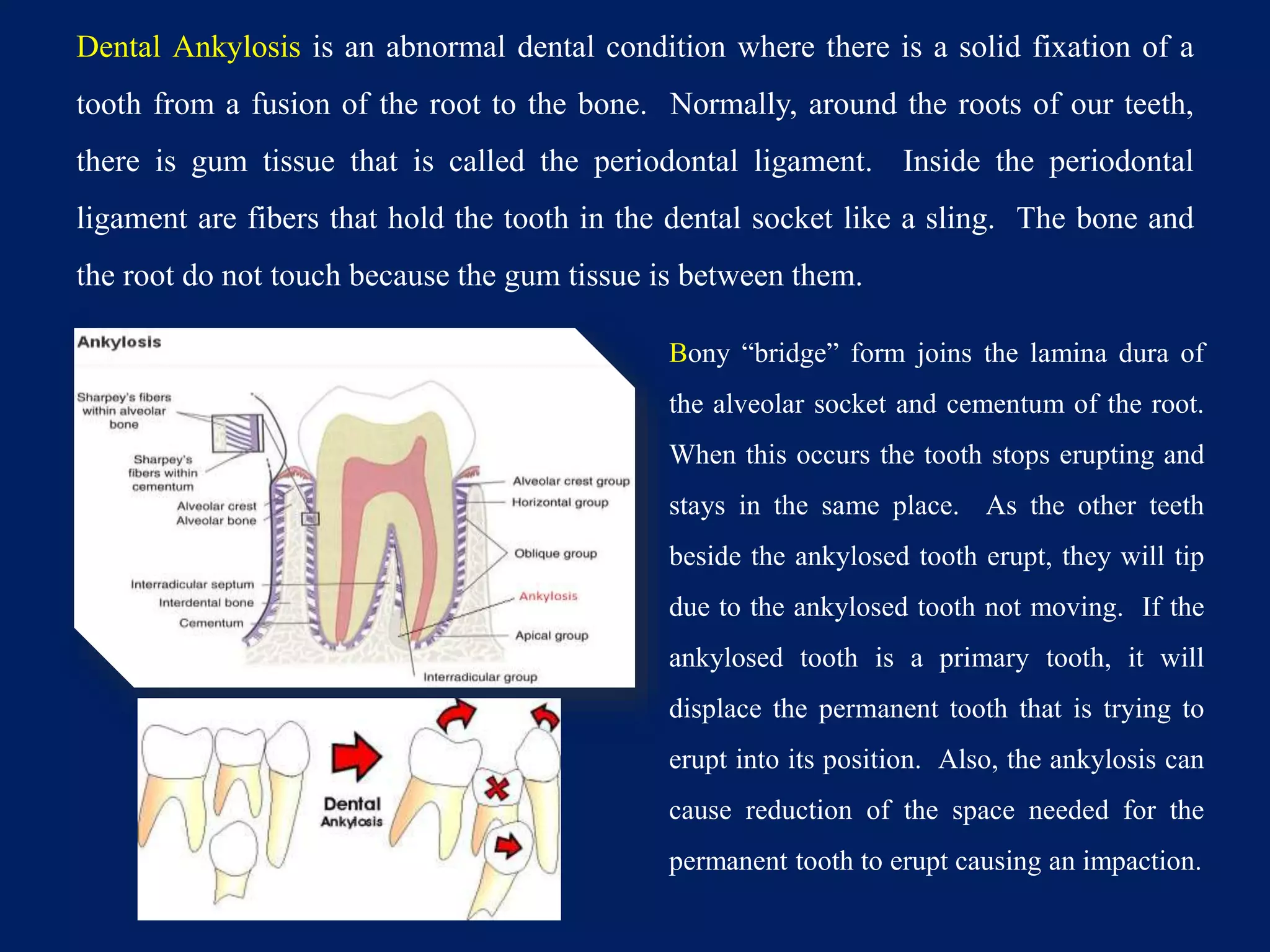 Dental Ankylosis is an abnormal dental condition where there is a solid fixation of a
tooth from a fusion of the root to the bone. Normally, around the roots of our teeth,
there is gum tissue that is called the periodontal ligament. Inside the periodontal
ligament are fibers that hold the tooth in the dental socket like a sling. The bone and
the root do not touch because the gum tissue is between them.
Bony “bridge” form joins the lamina dura of
the alveolar socket and cementum of the root.
When this occurs the tooth stops erupting and
stays in the same place. As the other teeth
beside the ankylosed tooth erupt, they will tip
due to the ankylosed tooth not moving. If the
ankylosed tooth is a primary tooth, it will
displace the permanent tooth that is trying to
erupt into its position. Also, the ankylosis can
cause reduction of the space needed for the
permanent tooth to erupt causing an impaction.
 