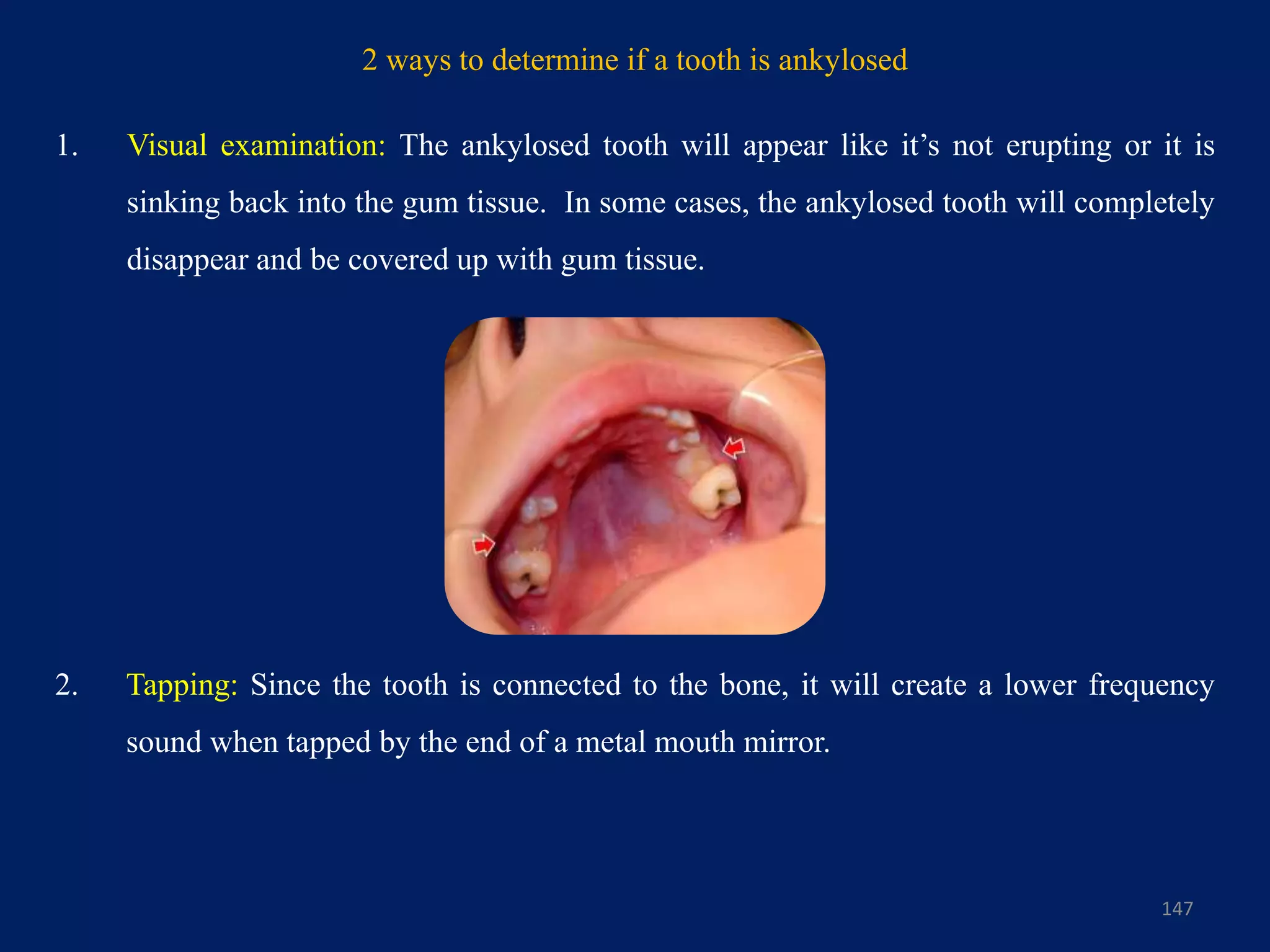 2 ways to determine if a tooth is ankylosed
1. Visual examination: The ankylosed tooth will appear like it’s not erupting or it is
sinking back into the gum tissue. In some cases, the ankylosed tooth will completely
disappear and be covered up with gum tissue.
147
2. Tapping: Since the tooth is connected to the bone, it will create a lower frequency
sound when tapped by the end of a metal mouth mirror.
 