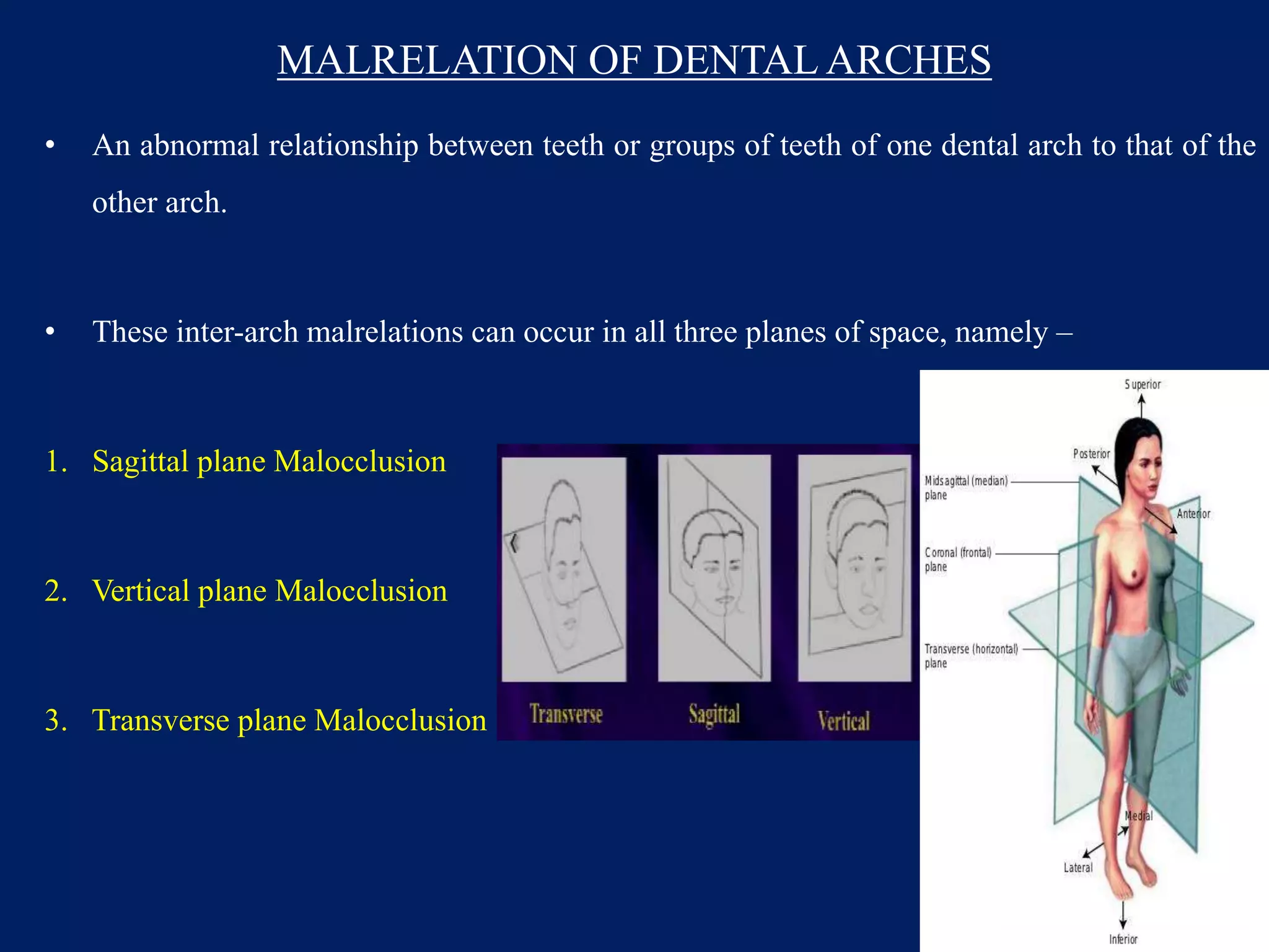 MALRELATION OF DENTAL ARCHES
• An abnormal relationship between teeth or groups of teeth of one dental arch to that of the
other arch.
• These inter-arch malrelations can occur in all three planes of space, namely –
1. Sagittal plane Malocclusion
2. Vertical plane Malocclusion
3. Transverse plane Malocclusion
16
 