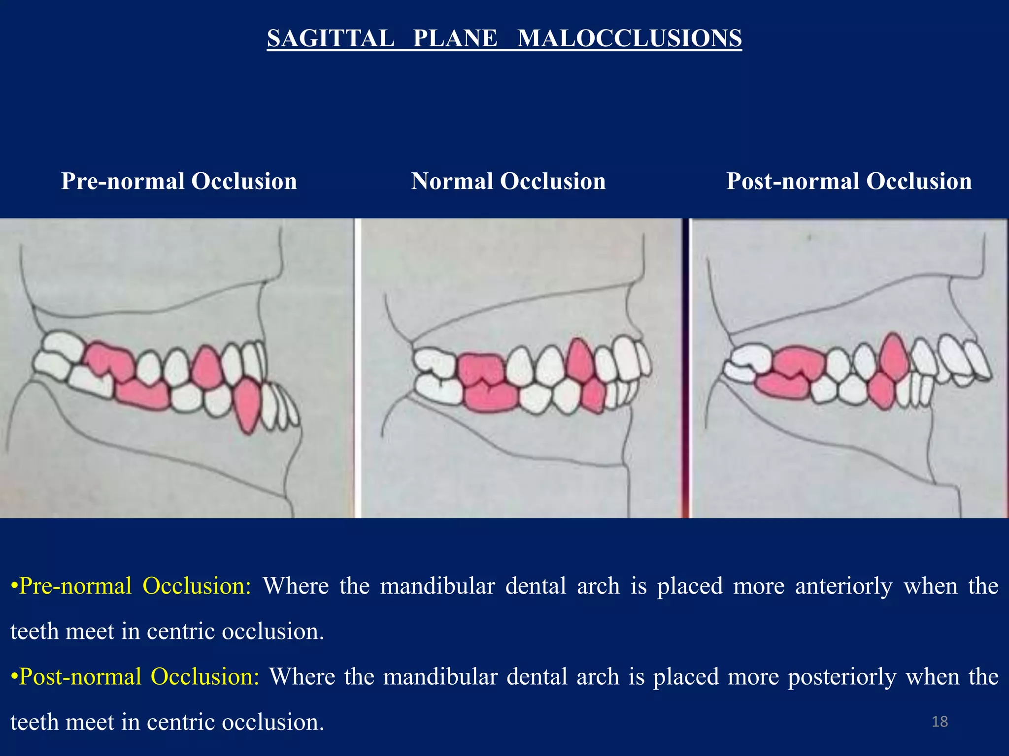 18
Pre-normal Occlusion Normal Occlusion Post-normal Occlusion
•Pre-normal Occlusion: Where the mandibular dental arch is placed more anteriorly when the
teeth meet in centric occlusion.
•Post-normal Occlusion: Where the mandibular dental arch is placed more posteriorly when the
teeth meet in centric occlusion.
SAGITTAL PLANE MALOCCLUSIONS
 