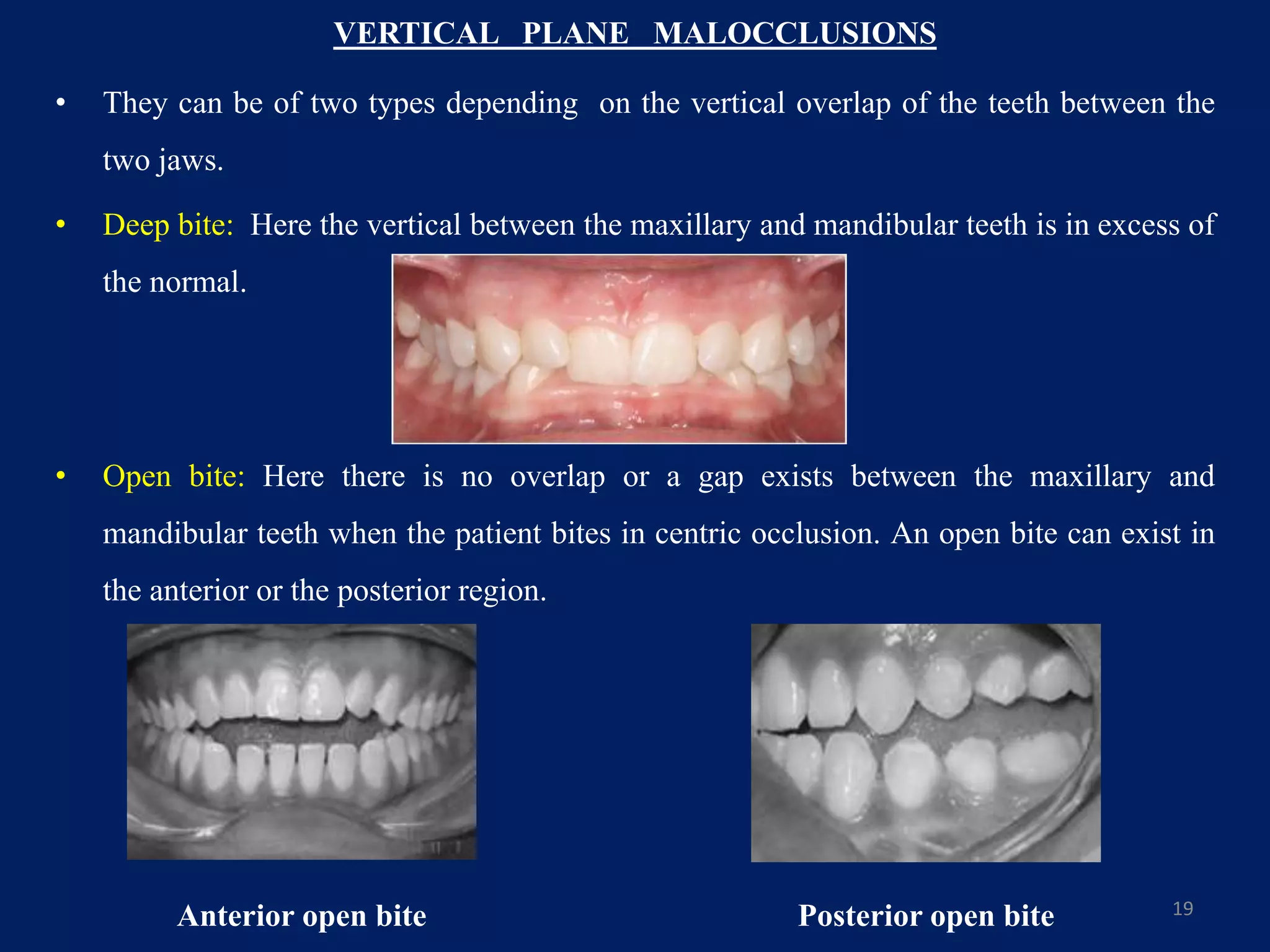 VERTICAL PLANE MALOCCLUSIONS
• They can be of two types depending on the vertical overlap of the teeth between the
two jaws.
• Deep bite: Here the vertical between the maxillary and mandibular teeth is in excess of
the normal.
• Open bite: Here there is no overlap or a gap exists between the maxillary and
mandibular teeth when the patient bites in centric occlusion. An open bite can exist in
the anterior or the posterior region.
19
Anterior open bite Posterior open bite
 