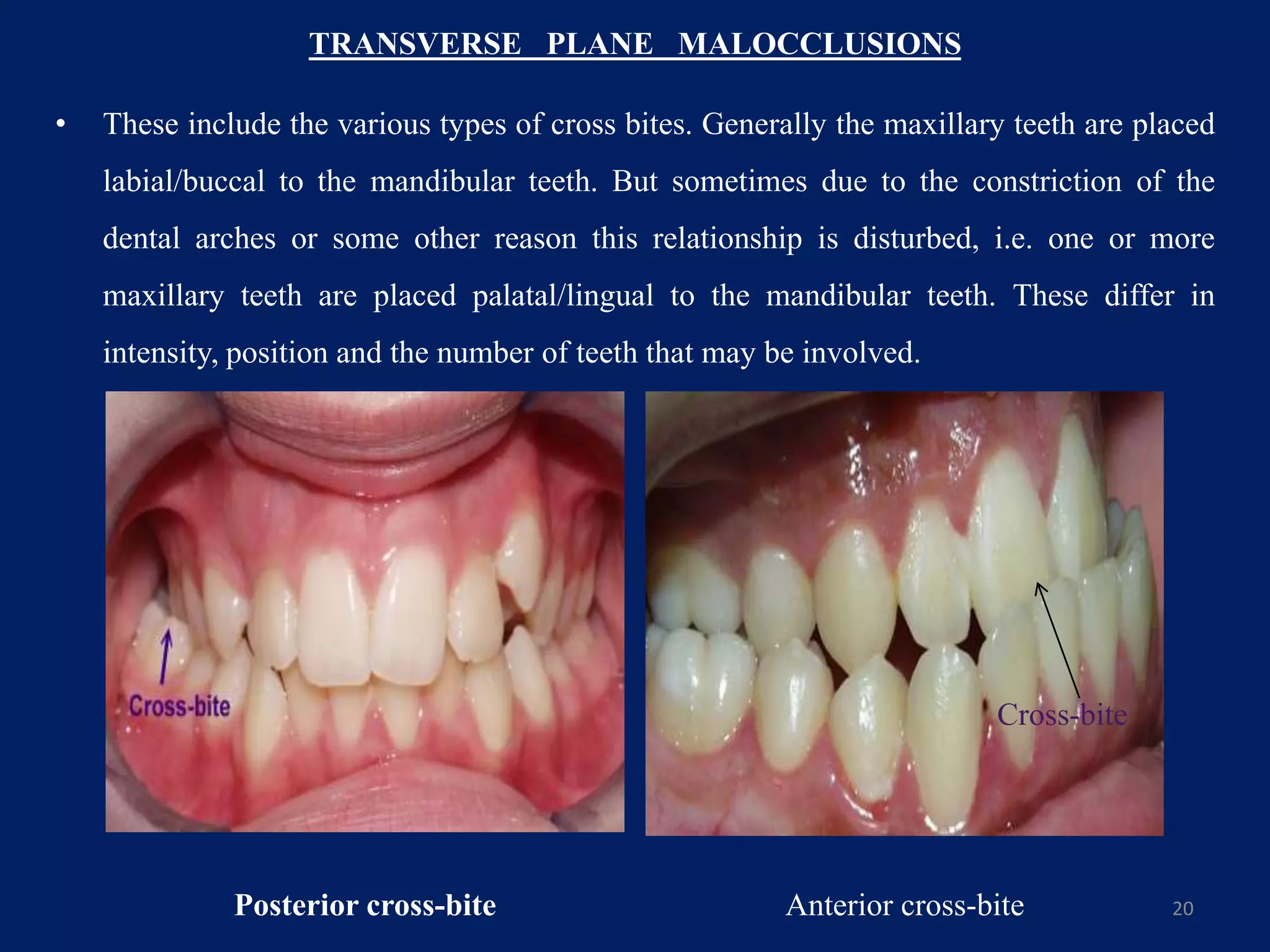TRANSVERSE PLANE MALOCCLUSIONS
• These include the various types of cross bites. Generally the maxillary teeth are placed
labial/buccal to the mandibular teeth. But sometimes due to the constriction of the
dental arches or some other reason this relationship is disturbed, i.e. one or more
maxillary teeth are placed palatal/lingual to the mandibular teeth. These differ in
intensity, position and the number of teeth that may be involved.
20Posterior cross-bite
Cross-bite
Anterior cross-bite
 
