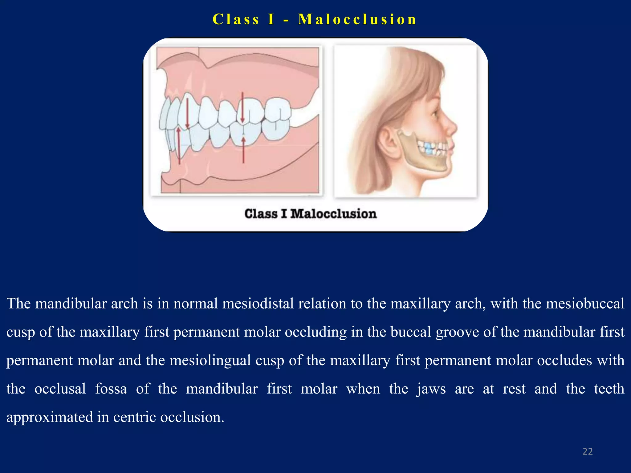 C l a s s I - M a l o c c l u s i o n
22
The mandibular arch is in normal mesiodistal relation to the maxillary arch, with the mesiobuccal
cusp of the maxillary first permanent molar occluding in the buccal groove of the mandibular first
permanent molar and the mesiolingual cusp of the maxillary first permanent molar occludes with
the occlusal fossa of the mandibular first molar when the jaws are at rest and the teeth
approximated in centric occlusion.
 