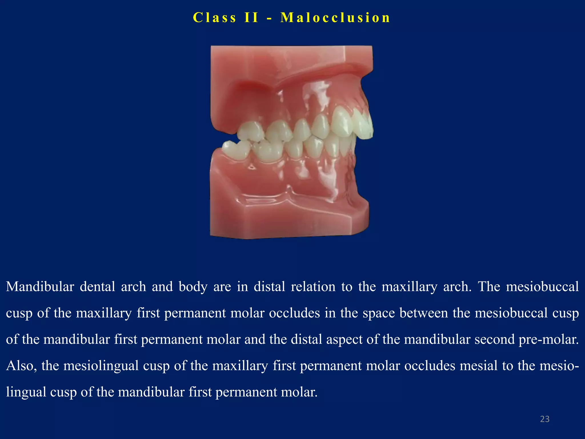 C l a s s I I - M a l o c c l u s i o n
23
Mandibular dental arch and body are in distal relation to the maxillary arch. The mesiobuccal
cusp of the maxillary first permanent molar occludes in the space between the mesiobuccal cusp
of the mandibular first permanent molar and the distal aspect of the mandibular second pre-molar.
Also, the mesiolingual cusp of the maxillary first permanent molar occludes mesial to the mesio-
lingual cusp of the mandibular first permanent molar.
 