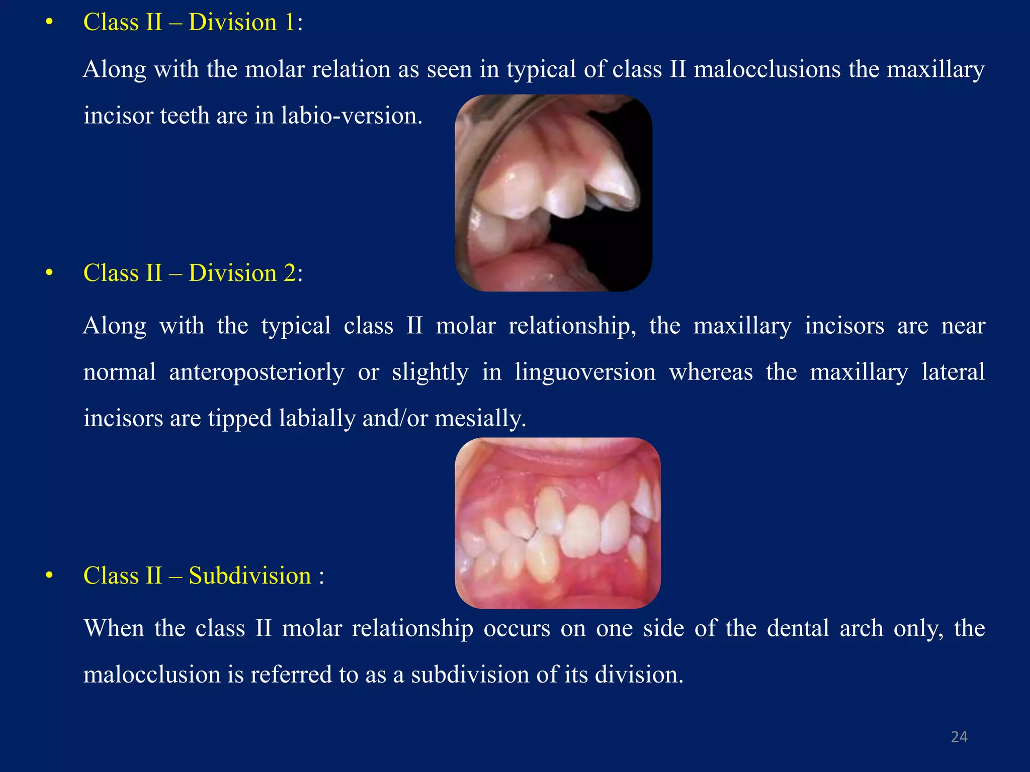 • Class II – Division 1:
Along with the molar relation as seen in typical of class II malocclusions the maxillary
incisor teeth are in labio-version.
• Class II – Division 2:
Along with the typical class II molar relationship, the maxillary incisors are near
normal anteroposteriorly or slightly in linguoversion whereas the maxillary lateral
incisors are tipped labially and/or mesially.
• Class II – Subdivision :
When the class II molar relationship occurs on one side of the dental arch only, the
malocclusion is referred to as a subdivision of its division.
24
 