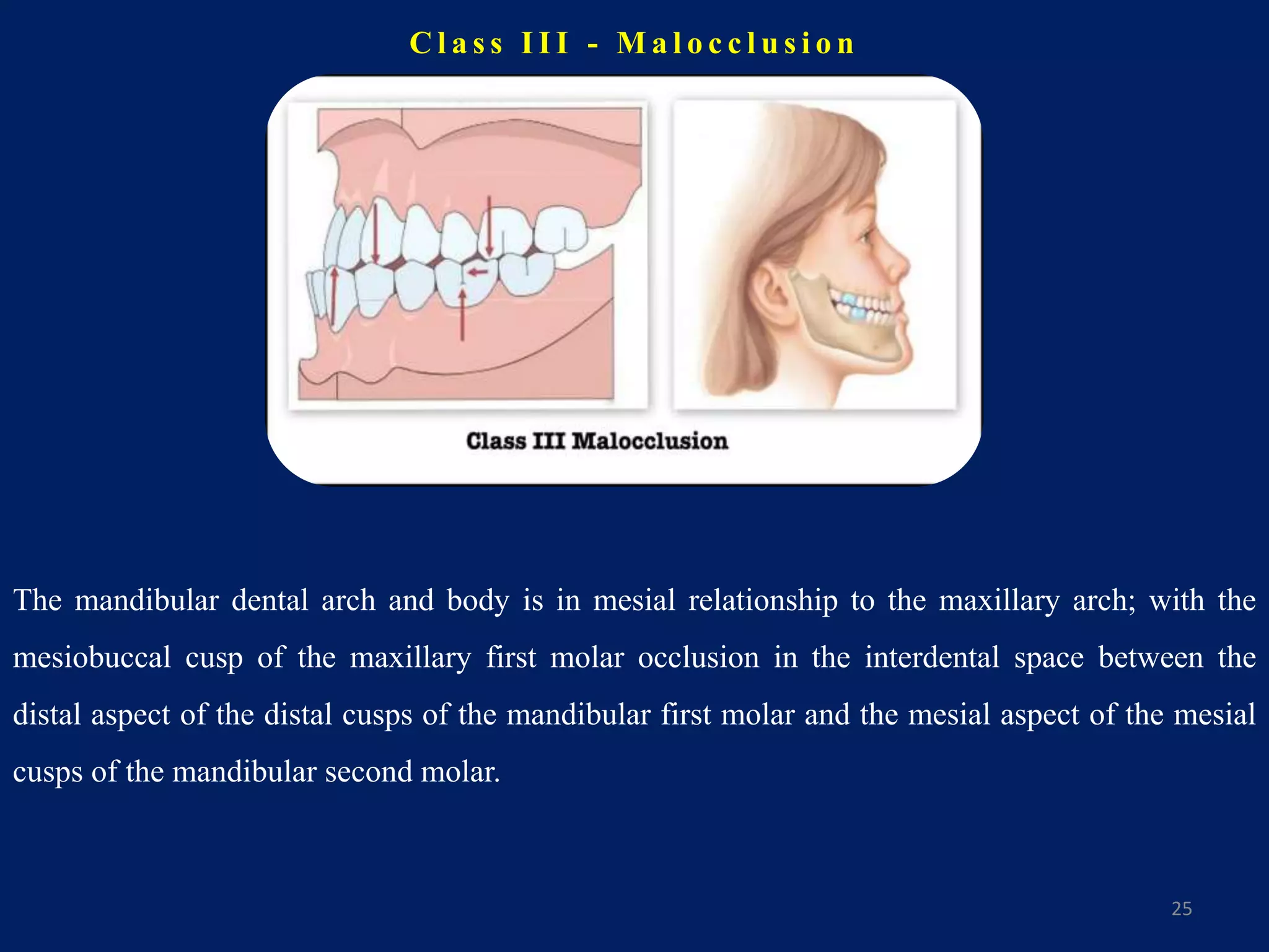 C l a s s I I I - M a l o c c l u s i o n
25
The mandibular dental arch and body is in mesial relationship to the maxillary arch; with the
mesiobuccal cusp of the maxillary first molar occlusion in the interdental space between the
distal aspect of the distal cusps of the mandibular first molar and the mesial aspect of the mesial
cusps of the mandibular second molar.
 