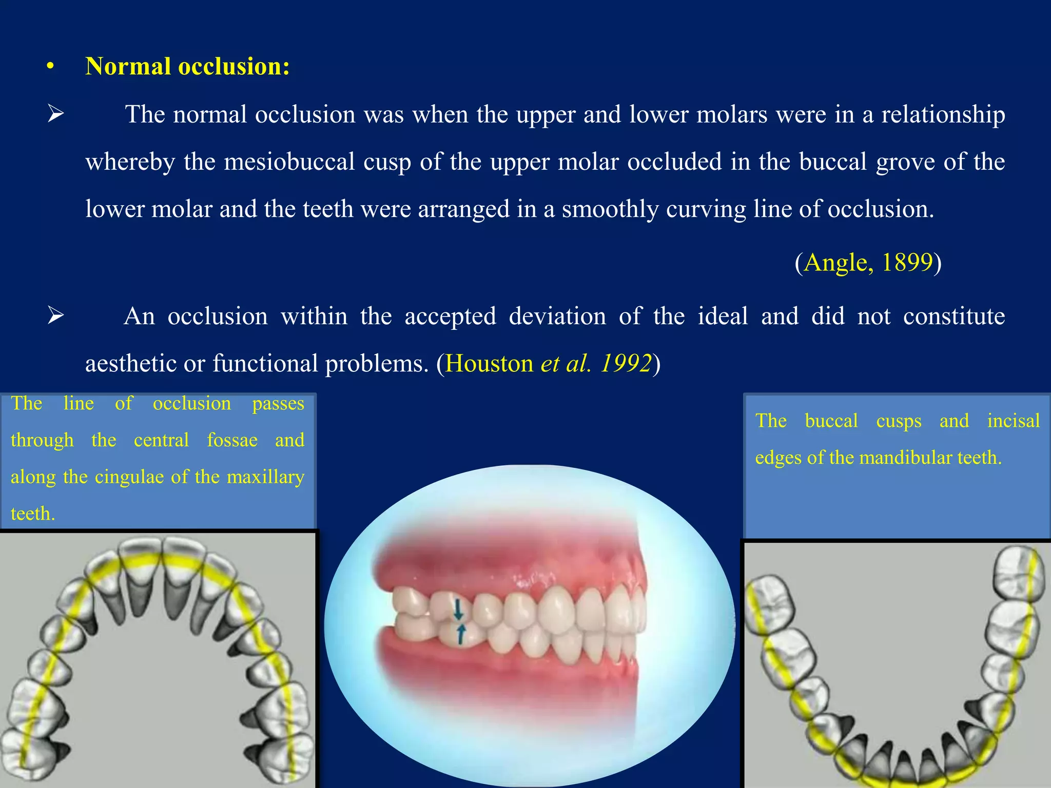 • Normal occlusion:
 The normal occlusion was when the upper and lower molars were in a relationship
whereby the mesiobuccal cusp of the upper molar occluded in the buccal grove of the
lower molar and the teeth were arranged in a smoothly curving line of occlusion.
(Angle, 1899)
 An occlusion within the accepted deviation of the ideal and did not constitute
aesthetic or functional problems. (Houston et al. 1992)
4
The line of occlusion passes
through the central fossae and
along the cingulae of the maxillary
teeth.
The buccal cusps and incisal
edges of the mandibular teeth.
 