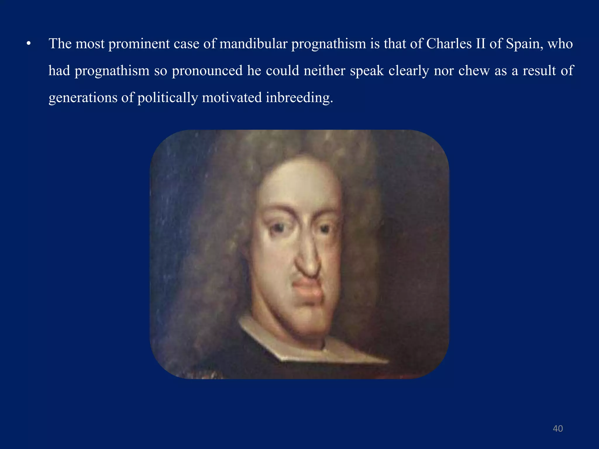 • The most prominent case of mandibular prognathism is that of Charles II of Spain, who
had prognathism so pronounced he could neither speak clearly nor chew as a result of
generations of politically motivated inbreeding.
40
 