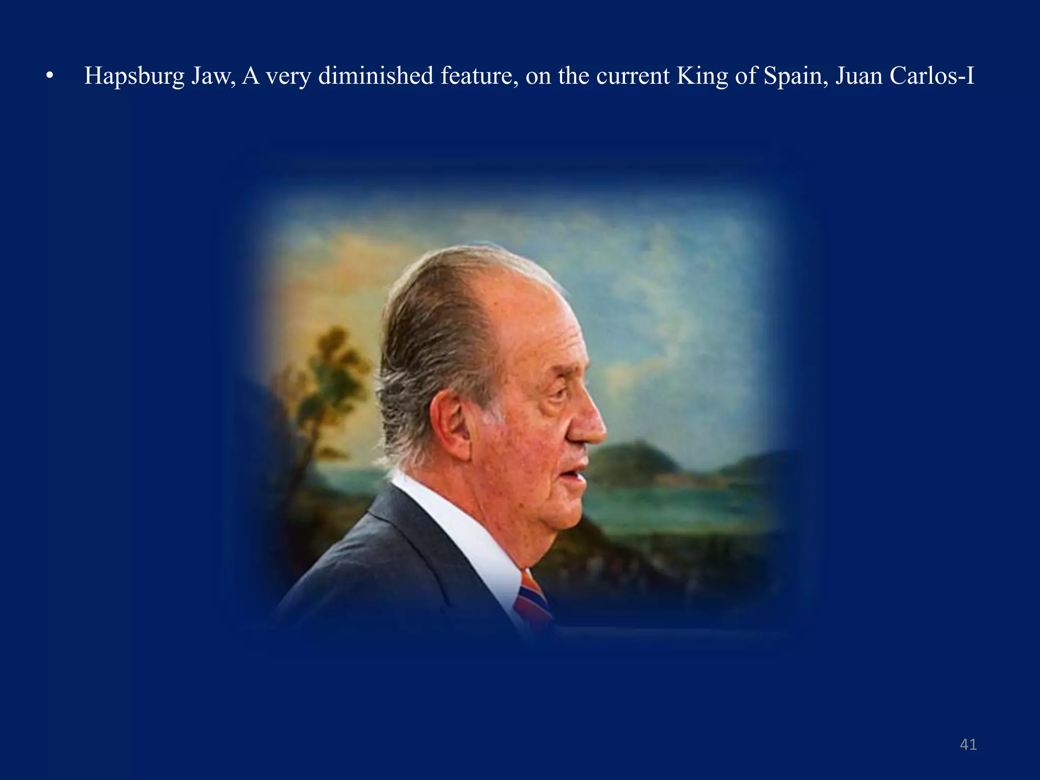 • Hapsburg Jaw, A very diminished feature, on the current King of Spain, Juan Carlos-I
41
 