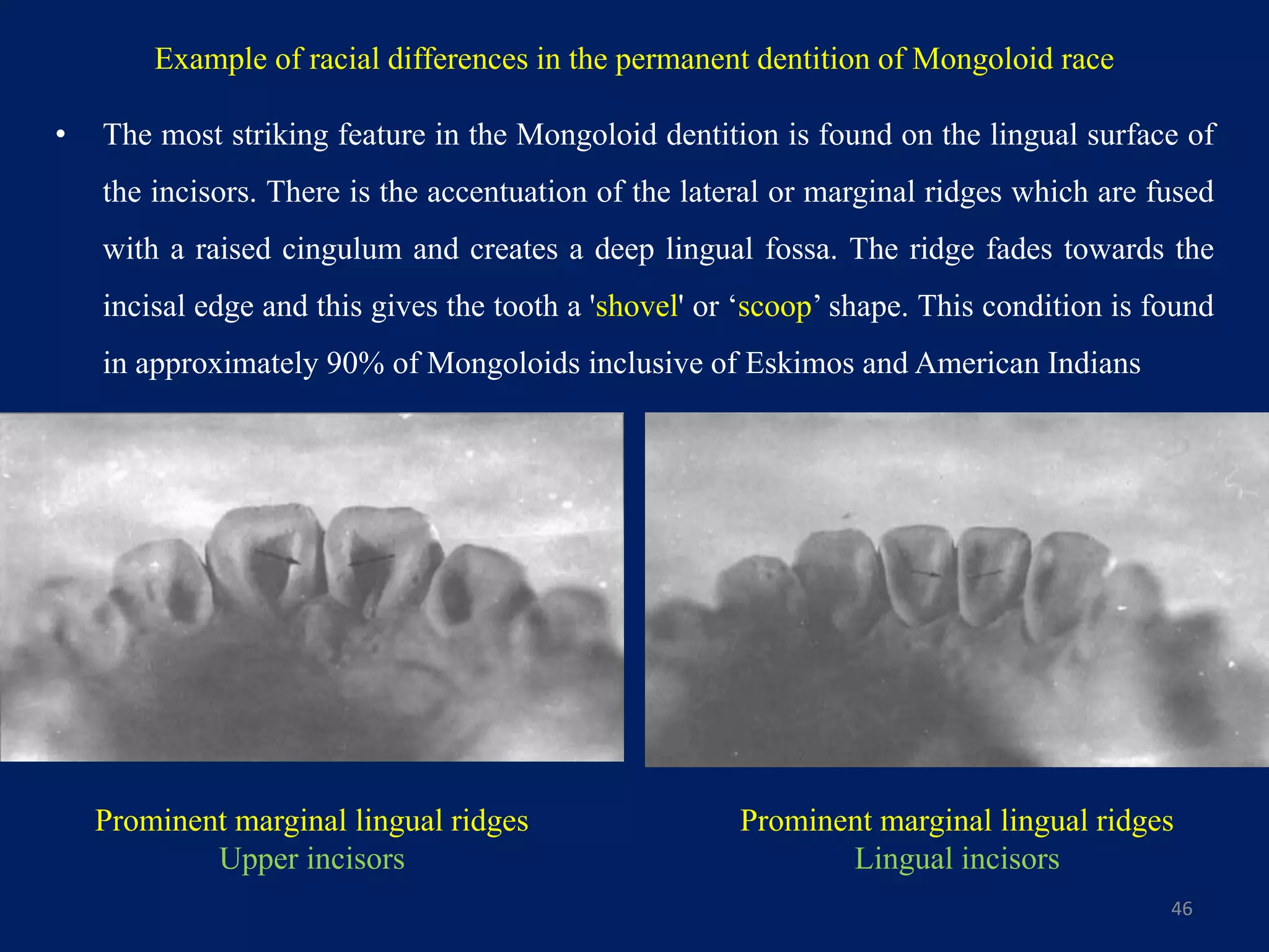 • The most striking feature in the Mongoloid dentition is found on the lingual surface of
the incisors. There is the accentuation of the lateral or marginal ridges which are fused
with a raised cingulum and creates a deep lingual fossa. The ridge fades towards the
incisal edge and this gives the tooth a 'shovel' or ‘scoop’ shape. This condition is found
in approximately 90% of Mongoloids inclusive of Eskimos and American Indians
46
Example of racial differences in the permanent dentition of Mongoloid race
Prominent marginal lingual ridges
Upper incisors
Prominent marginal lingual ridges
Lingual incisors
 
