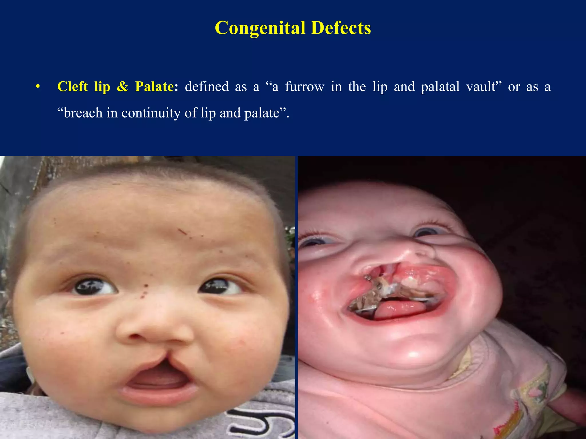Congenital Defects
• Cleft lip & Palate: defined as a “a furrow in the lip and palatal vault” or as a
“breach in continuity of lip and palate”.
50
 