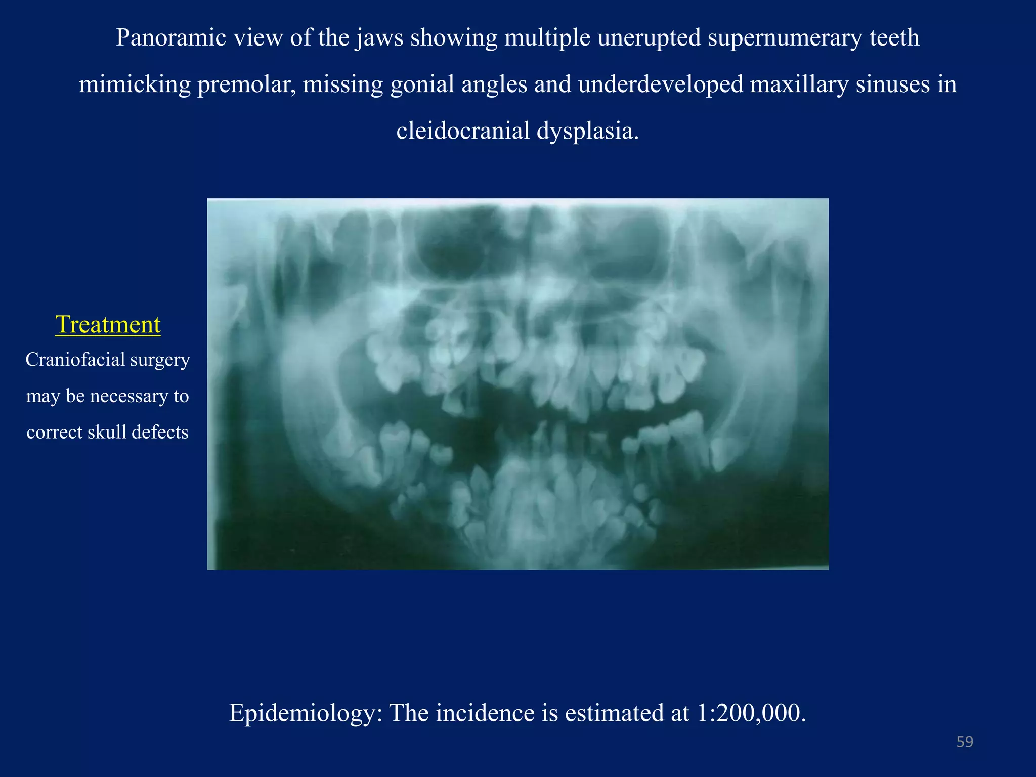 Panoramic view of the jaws showing multiple unerupted supernumerary teeth
mimicking premolar, missing gonial angles and underdeveloped maxillary sinuses in
cleidocranial dysplasia.
59
Epidemiology: The incidence is estimated at 1:200,000.
Treatment
Craniofacial surgery
may be necessary to
correct skull defects
 