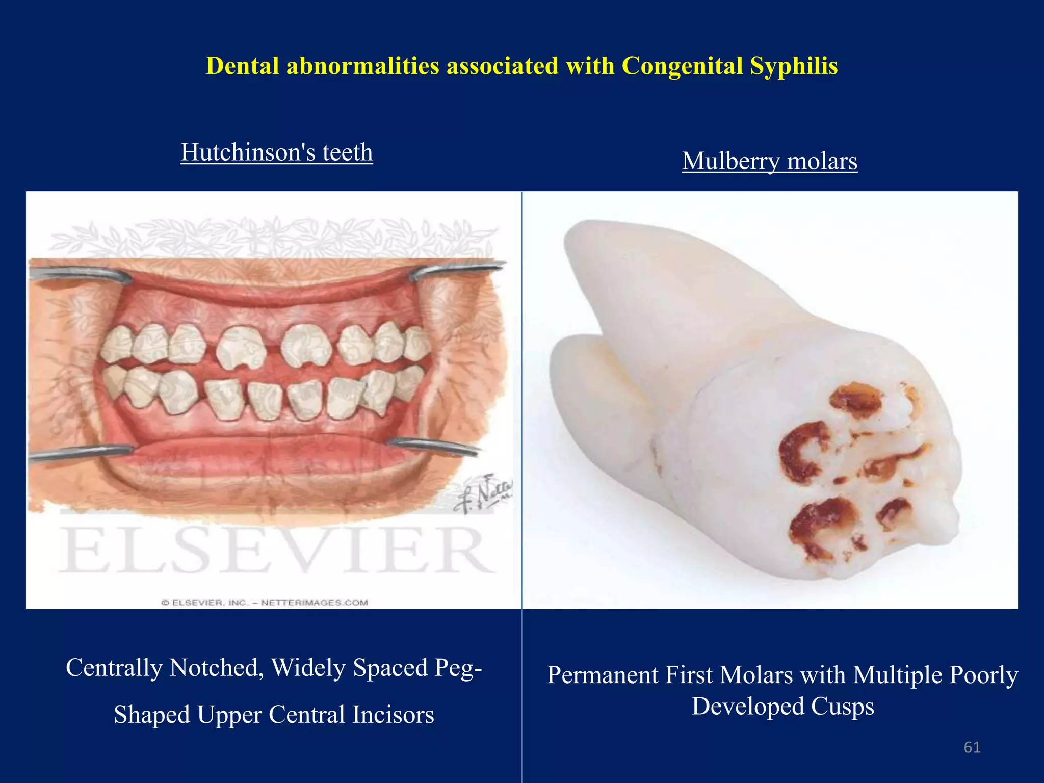 Dental abnormalities associated with Congenital Syphilis
61
Hutchinson's teeth
Centrally Notched, Widely Spaced Peg-
Shaped Upper Central Incisors
Permanent First Molars with Multiple Poorly
Developed Cusps
Mulberry molars
 