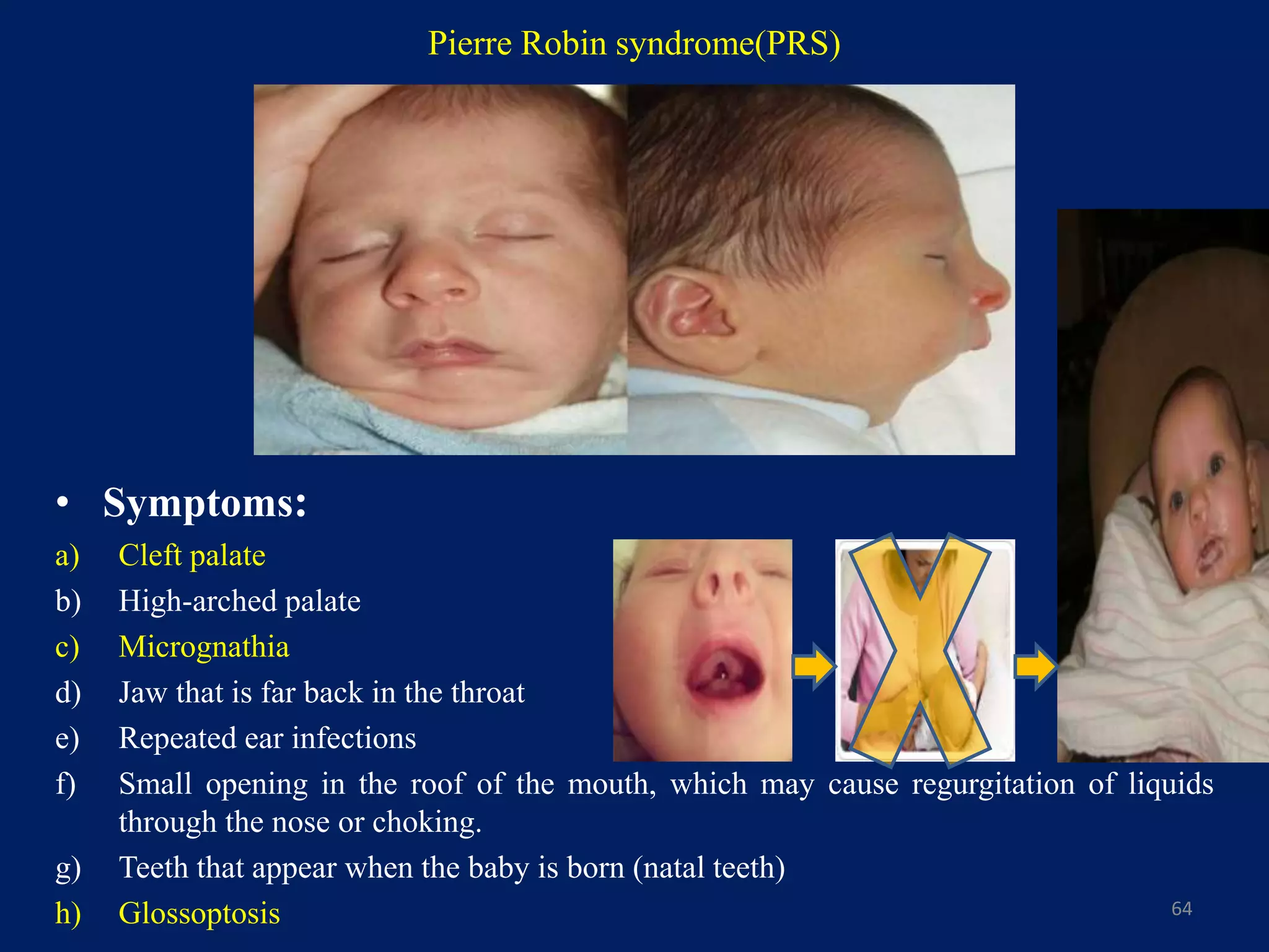 Pierre Robin syndrome(PRS)
• Symptoms:
a) Cleft palate
b) High-arched palate
c) Micrognathia
d) Jaw that is far back in the throat
e) Repeated ear infections
f) Small opening in the roof of the mouth, which may cause regurgitation of liquids
through the nose or choking.
g) Teeth that appear when the baby is born (natal teeth)
h) Glossoptosis 64
 