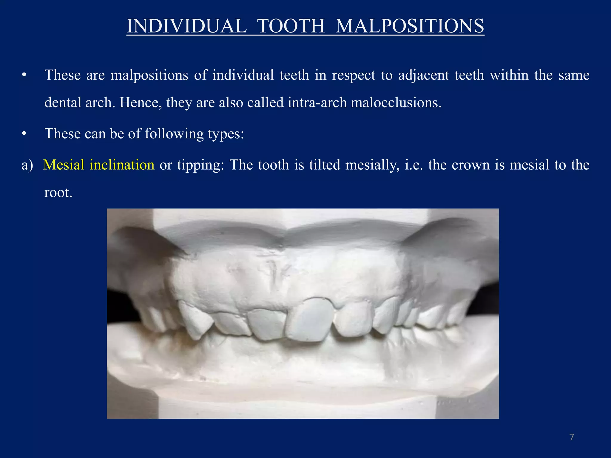 INDIVIDUAL TOOTH MALPOSITIONS
• These are malpositions of individual teeth in respect to adjacent teeth within the same
dental arch. Hence, they are also called intra-arch malocclusions.
• These can be of following types:
a) Mesial inclination or tipping: The tooth is tilted mesially, i.e. the crown is mesial to the
root.
7
 