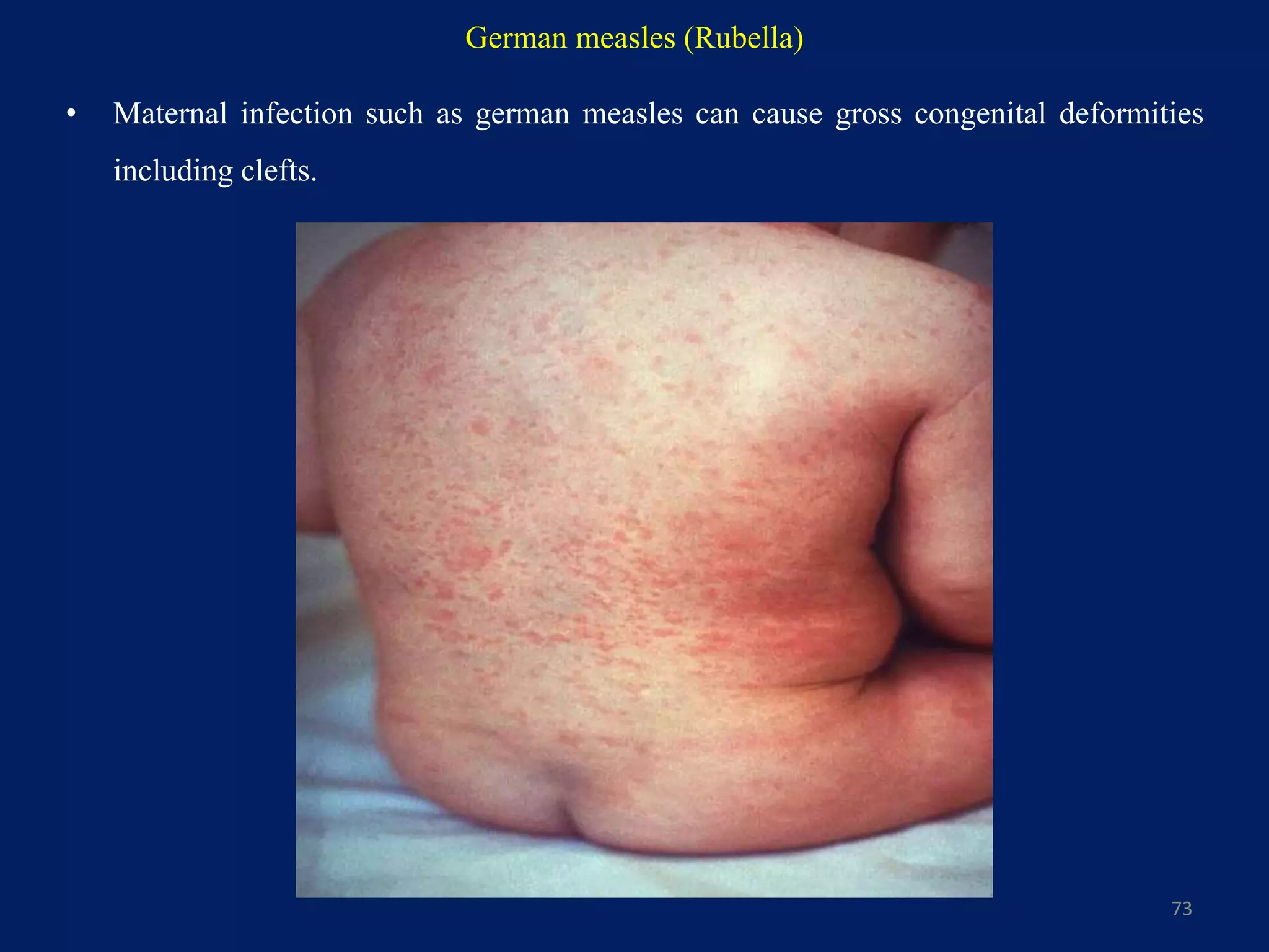 German measles (Rubella)
• Maternal infection such as german measles can cause gross congenital deformities
including clefts.
73
 