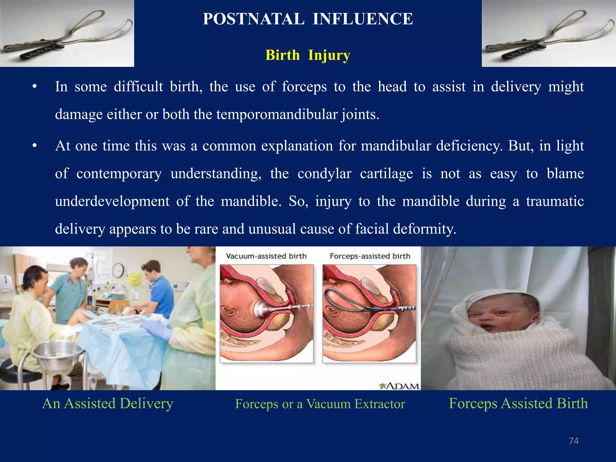 POSTNATAL INFLUENCE
Birth Injury
• In some difficult birth, the use of forceps to the head to assist in delivery might
damage either or both the temporomandibular joints.
• At one time this was a common explanation for mandibular deficiency. But, in light
of contemporary understanding, the condylar cartilage is not as easy to blame
underdevelopment of the mandible. So, injury to the mandible during a traumatic
delivery appears to be rare and unusual cause of facial deformity.
74
Forceps or a Vacuum ExtractorAn Assisted Delivery Forceps Assisted Birth
 