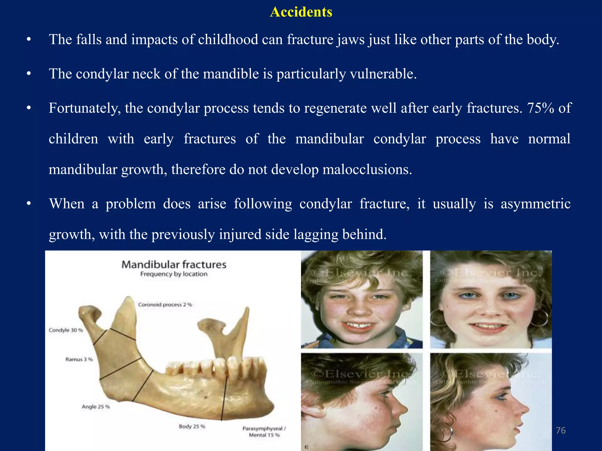 Accidents
• The falls and impacts of childhood can fracture jaws just like other parts of the body.
• The condylar neck of the mandible is particularly vulnerable.
• Fortunately, the condylar process tends to regenerate well after early fractures. 75% of
children with early fractures of the mandibular condylar process have normal
mandibular growth, therefore do not develop malocclusions.
• When a problem does arise following condylar fracture, it usually is asymmetric
growth, with the previously injured side lagging behind.
76
 
