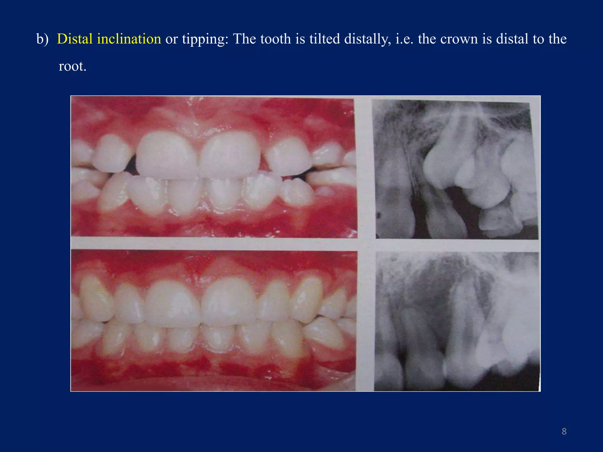 b) Distal inclination or tipping: The tooth is tilted distally, i.e. the crown is distal to the
root.
8
 