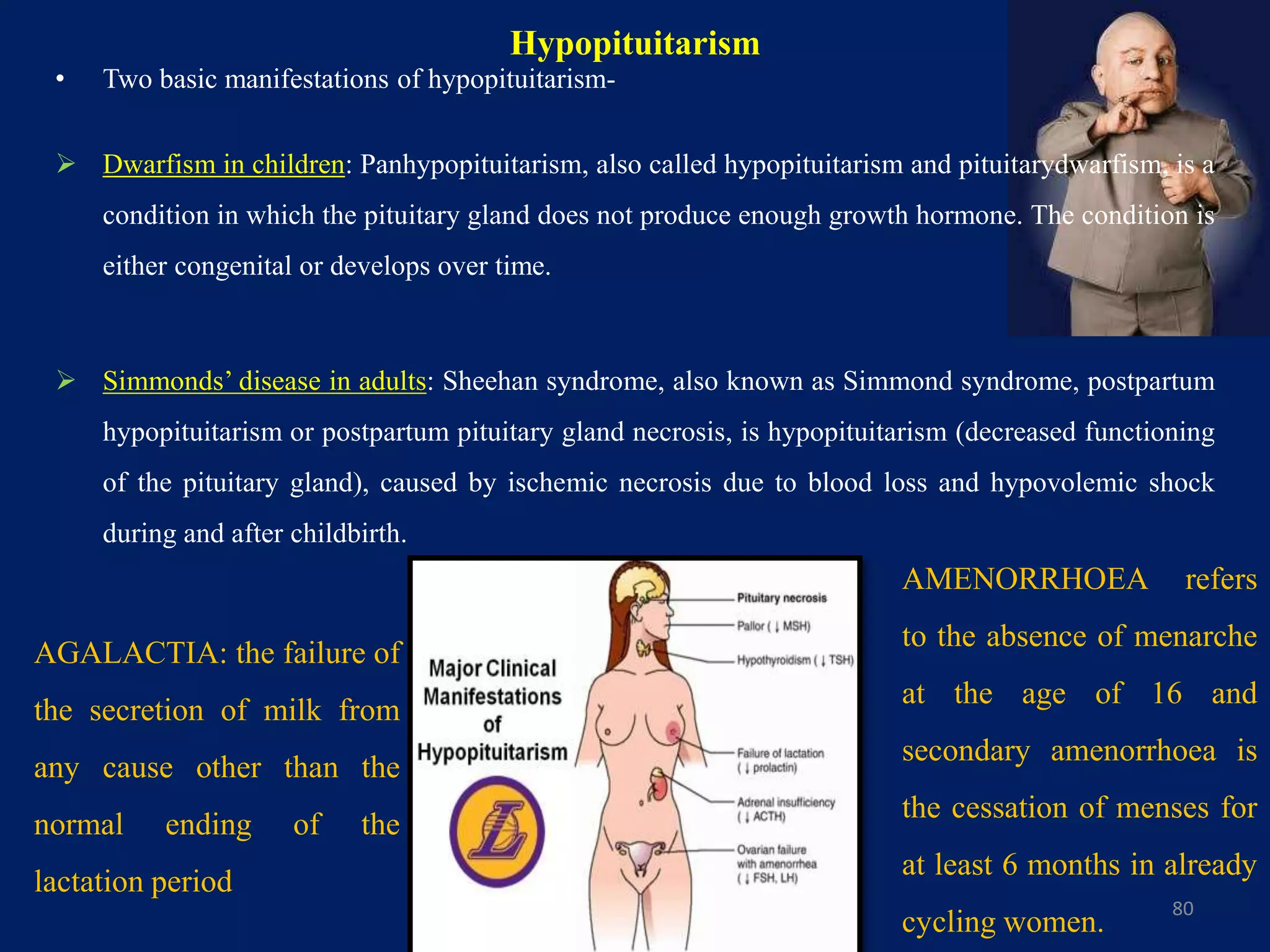 Hypopituitarism
• Two basic manifestations of hypopituitarism-
 Dwarfism in children: Panhypopituitarism, also called hypopituitarism and pituitarydwarfism, is a
condition in which the pituitary gland does not produce enough growth hormone. The condition is
either congenital or develops over time.
 Simmonds’ disease in adults: Sheehan syndrome, also known as Simmond syndrome, postpartum
hypopituitarism or postpartum pituitary gland necrosis, is hypopituitarism (decreased functioning
of the pituitary gland), caused by ischemic necrosis due to blood loss and hypovolemic shock
during and after childbirth.
80
AMENORRHOEA refers
to the absence of menarche
at the age of 16 and
secondary amenorrhoea is
the cessation of menses for
at least 6 months in already
cycling women.
AGALACTIA: the failure of
the secretion of milk from
any cause other than the
normal ending of the
lactation period
 