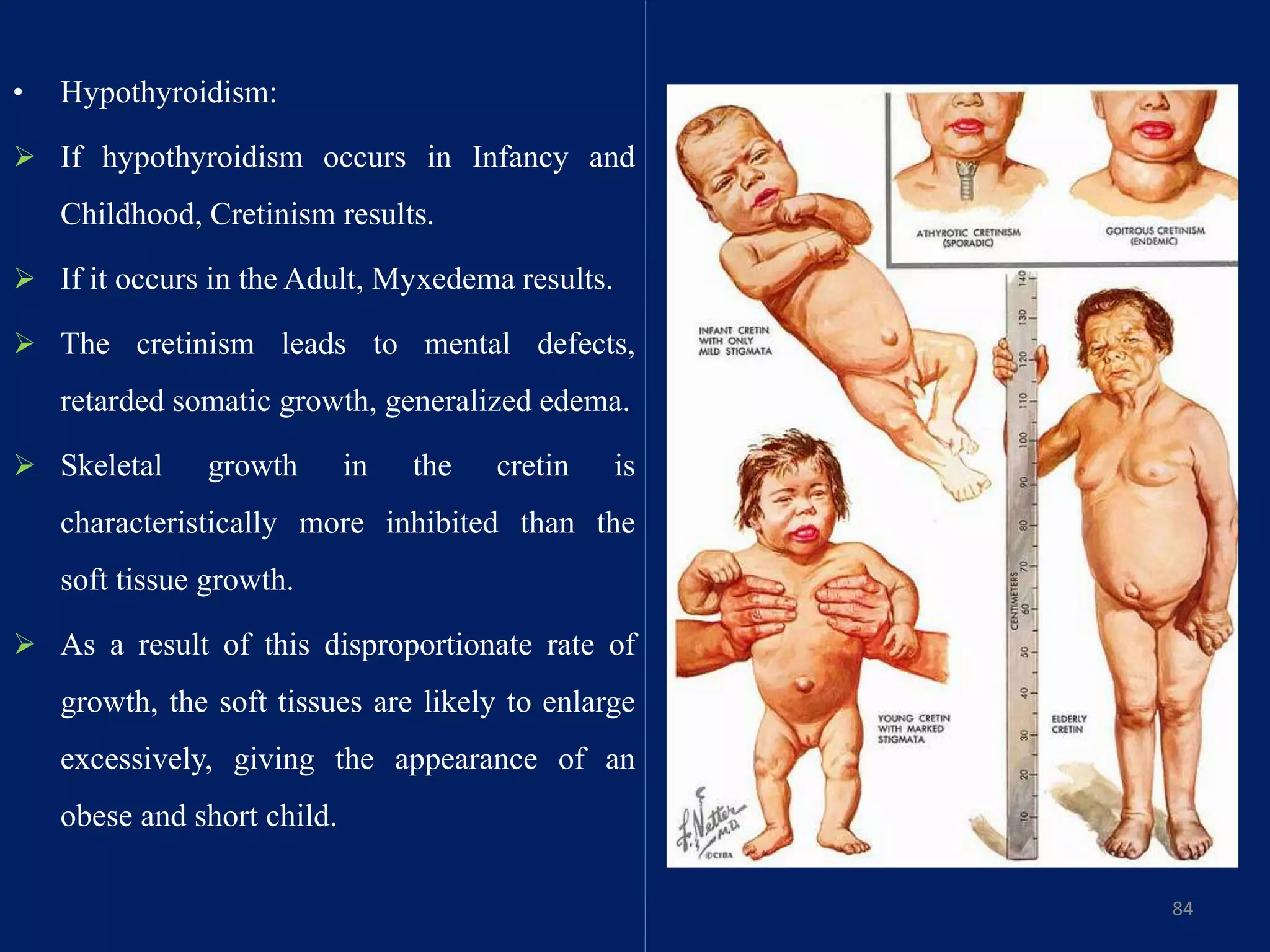 • Hypothyroidism:
 If hypothyroidism occurs in Infancy and
Childhood, Cretinism results.
 If it occurs in the Adult, Myxedema results.
 The cretinism leads to mental defects,
retarded somatic growth, generalized edema.
 Skeletal growth in the cretin is
characteristically more inhibited than the
soft tissue growth.
 As a result of this disproportionate rate of
growth, the soft tissues are likely to enlarge
excessively, giving the appearance of an
obese and short child.
84
 