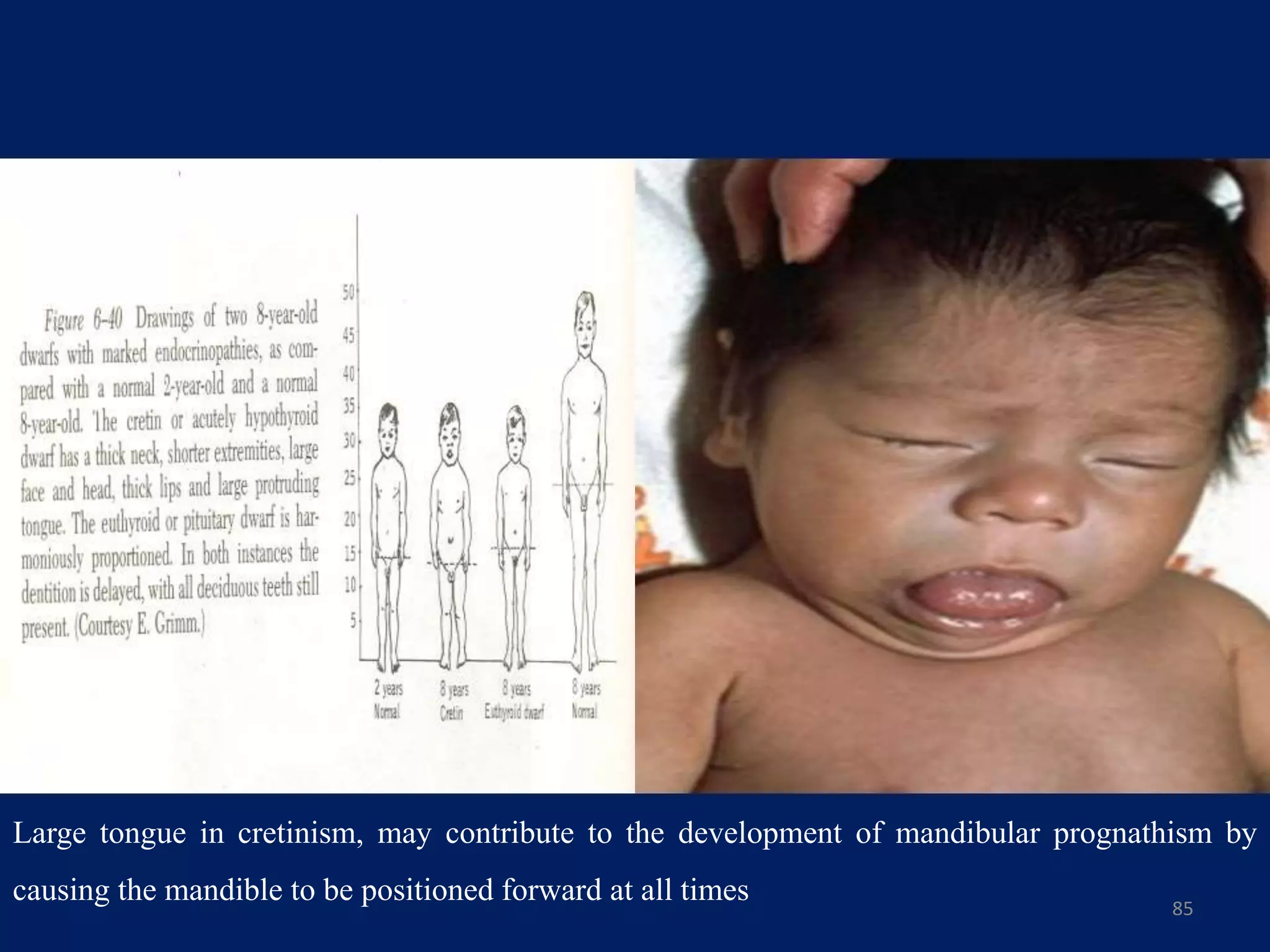 85
Large tongue in cretinism, may contribute to the development of mandibular prognathism by
causing the mandible to be positioned forward at all times
 