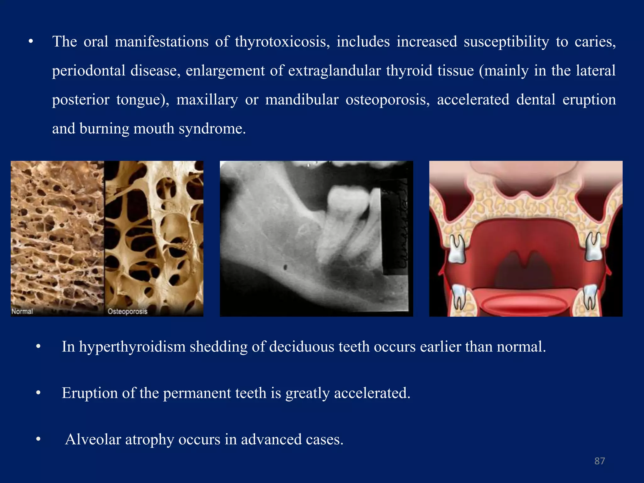 • The oral manifestations of thyrotoxicosis, includes increased susceptibility to caries,
periodontal disease, enlargement of extraglandular thyroid tissue (mainly in the lateral
posterior tongue), maxillary or mandibular osteoporosis, accelerated dental eruption
and burning mouth syndrome.
87
• In hyperthyroidism shedding of deciduous teeth occurs earlier than normal.
• Eruption of the permanent teeth is greatly accelerated.
• Alveolar atrophy occurs in advanced cases.
 