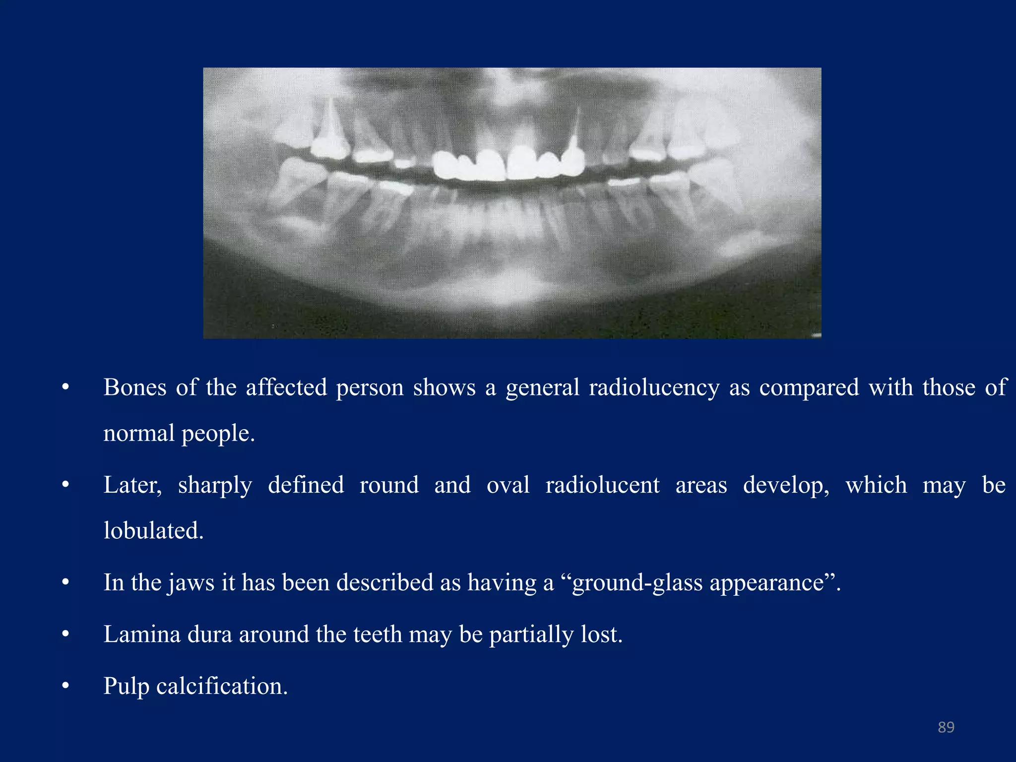 • Bones of the affected person shows a general radiolucency as compared with those of
normal people.
• Later, sharply defined round and oval radiolucent areas develop, which may be
lobulated.
• In the jaws it has been described as having a “ground-glass appearance”.
• Lamina dura around the teeth may be partially lost.
• Pulp calcification.
89
 
