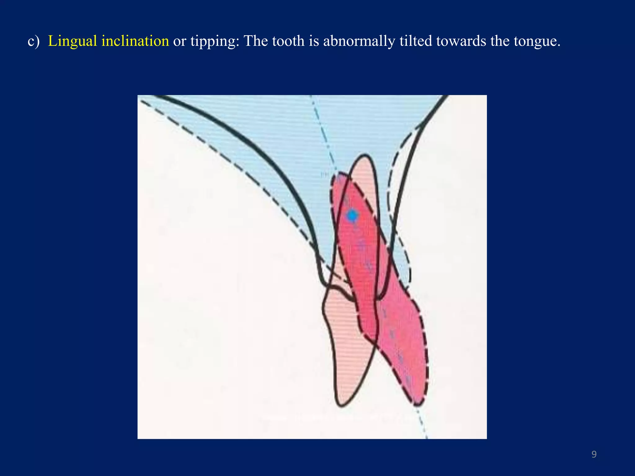 c) Lingual inclination or tipping: The tooth is abnormally tilted towards the tongue.
9
 