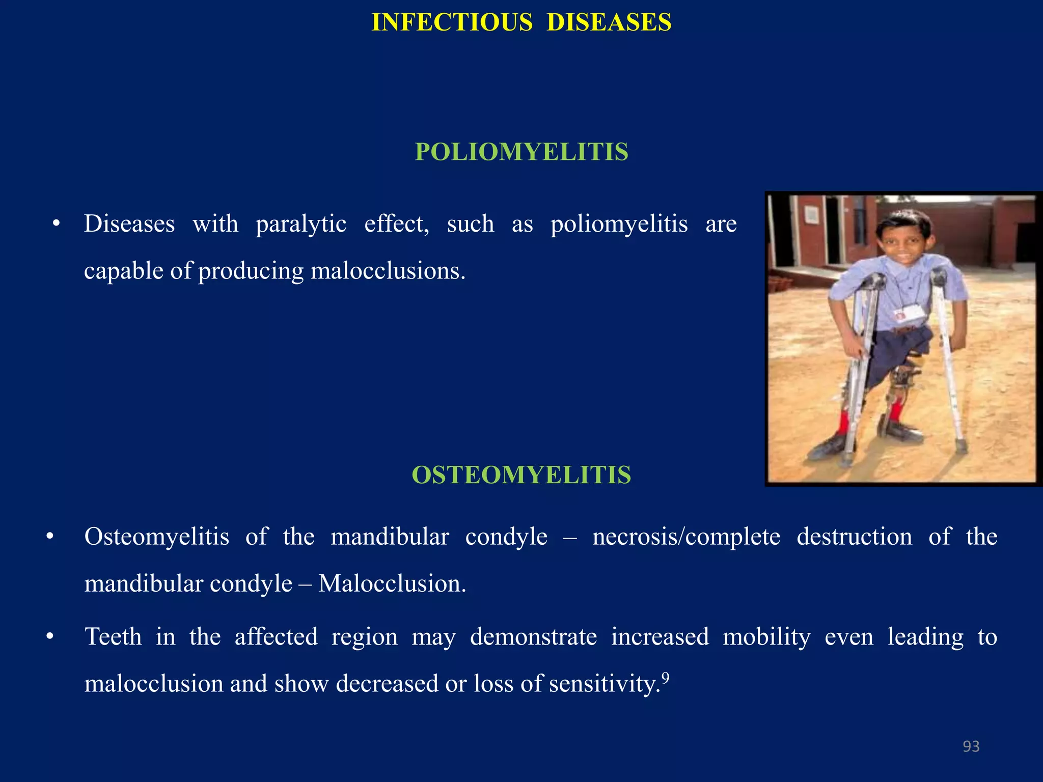 OSTEOMYELITIS
• Osteomyelitis of the mandibular condyle – necrosis/complete destruction of the
mandibular condyle – Malocclusion.
• Teeth in the affected region may demonstrate increased mobility even leading to
malocclusion and show decreased or loss of sensitivity.9
93
INFECTIOUS DISEASES
• Diseases with paralytic effect, such as poliomyelitis are
capable of producing malocclusions.
POLIOMYELITIS
 