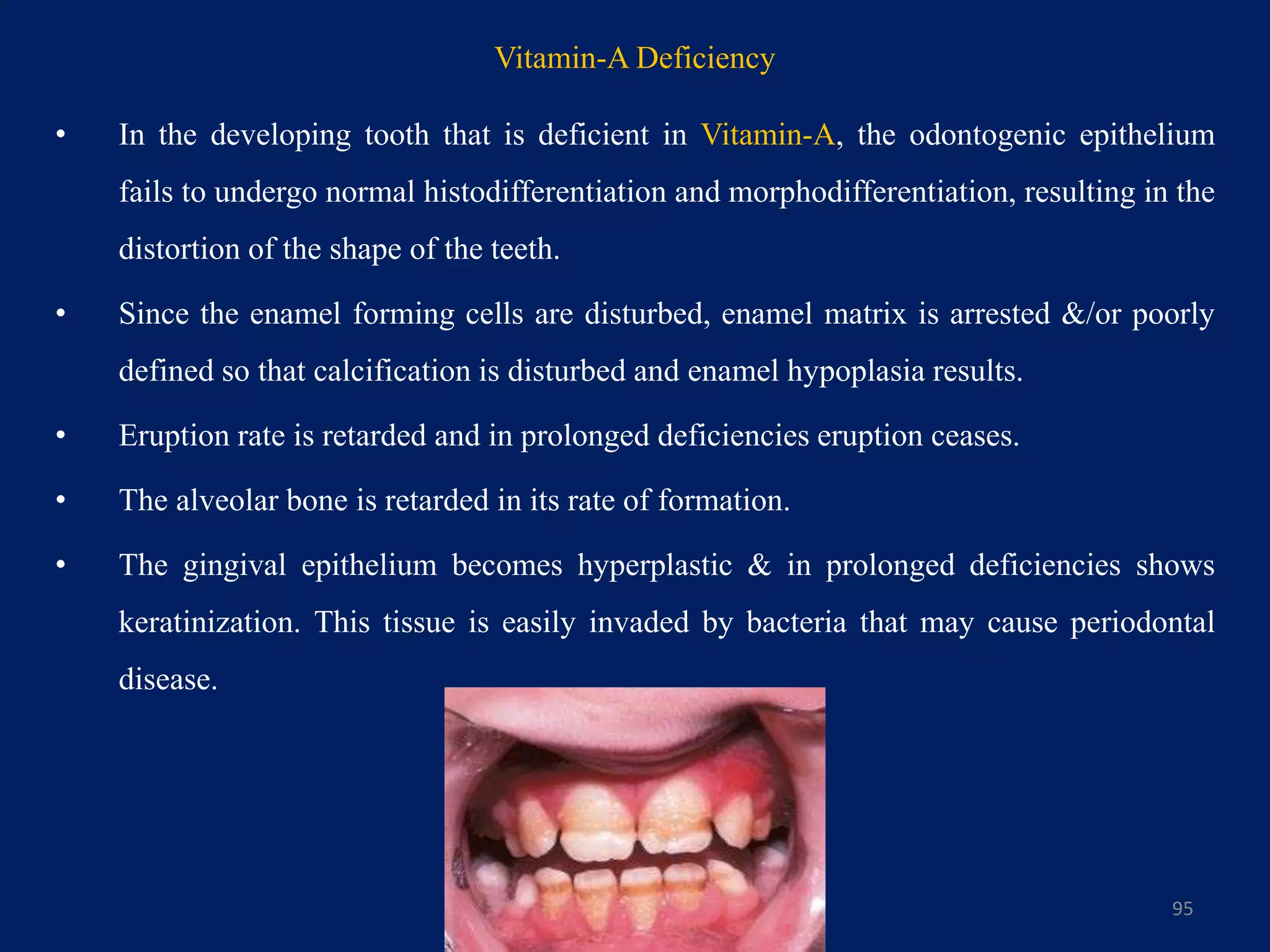 • In the developing tooth that is deficient in Vitamin-A, the odontogenic epithelium
fails to undergo normal histodifferentiation and morphodifferentiation, resulting in the
distortion of the shape of the teeth.
• Since the enamel forming cells are disturbed, enamel matrix is arrested &/or poorly
defined so that calcification is disturbed and enamel hypoplasia results.
• Eruption rate is retarded and in prolonged deficiencies eruption ceases.
• The alveolar bone is retarded in its rate of formation.
• The gingival epithelium becomes hyperplastic & in prolonged deficiencies shows
keratinization. This tissue is easily invaded by bacteria that may cause periodontal
disease.
95
Vitamin-A Deficiency
 