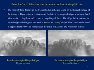 Fused Ridge Example Diagram Epidemiology of malocclusion | PPTX