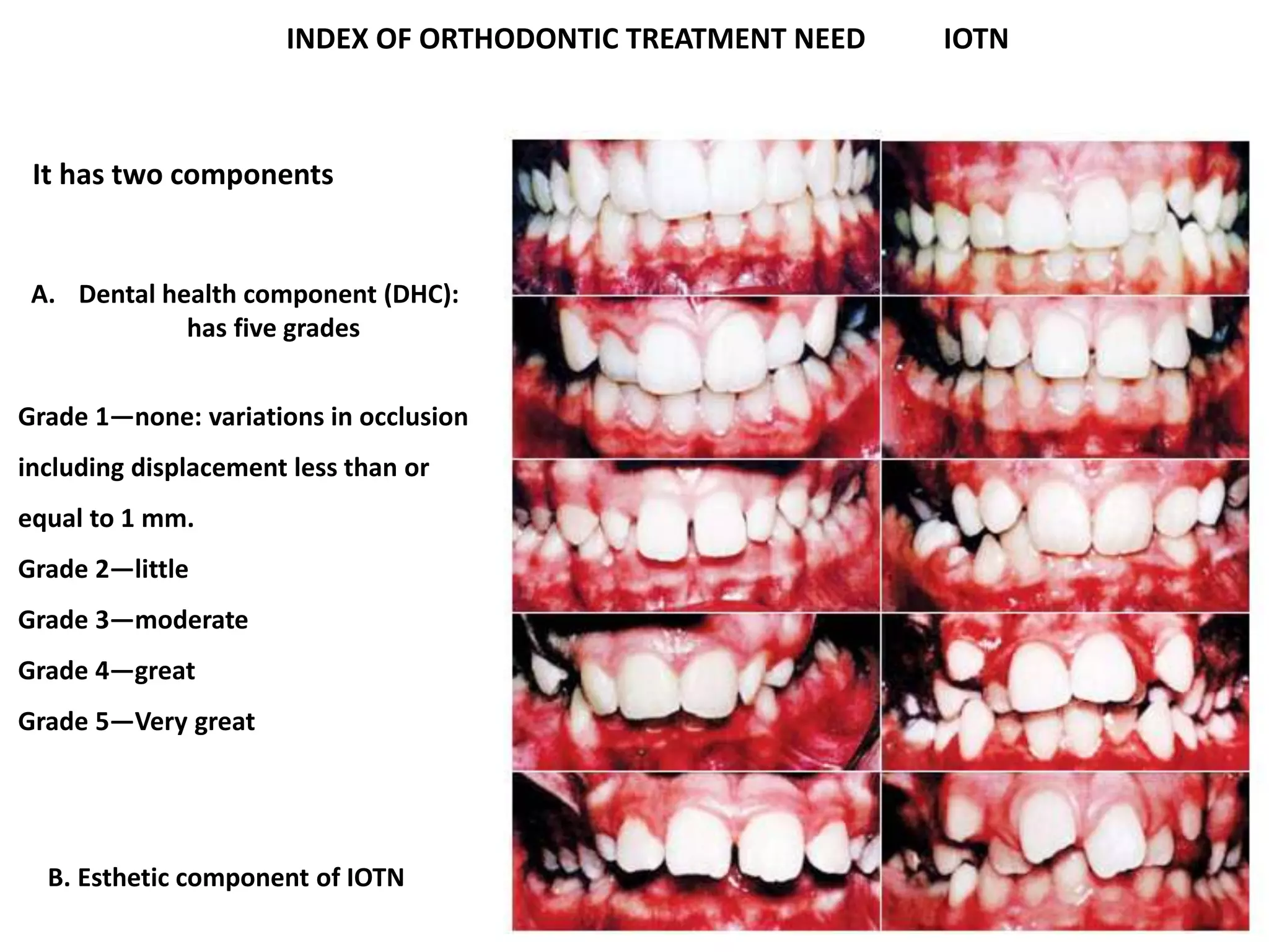 epidemiology-of-malocclusion-dr-nabil-al-zubair-pdf
