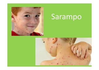Sarampo
 