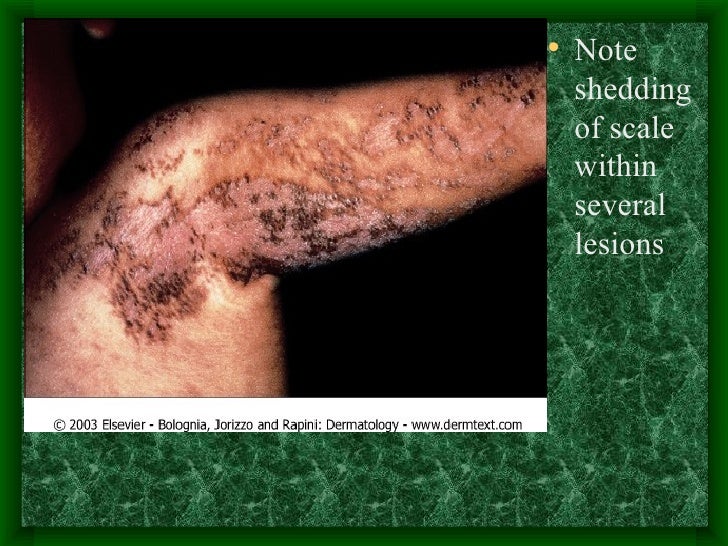 Epidermal Nevi, Neoplasms and Cysts – Part 1 Epidermal 