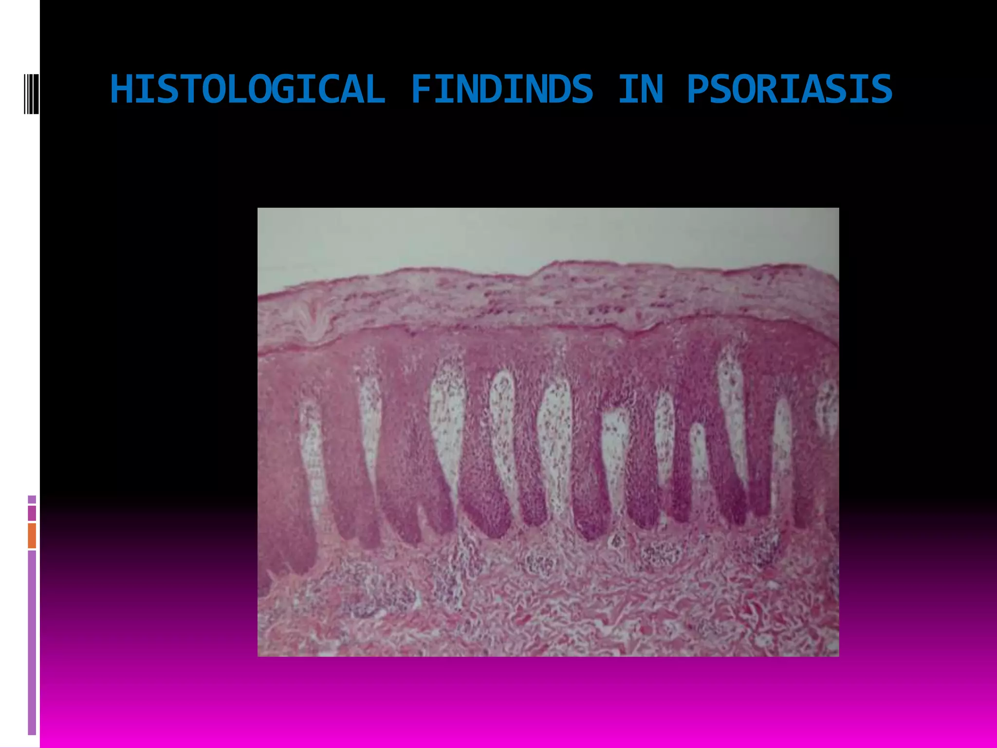 HISTOLOGICAL FINDINDS IN PSORIASIS
 