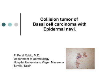 Collision tumor of  B asal cell carcinoma with Epidermal nevi . F. Peral Rubio, M.D. Department of Dermatology Hospital Universitario Virgen Macarena Seville, Spain 