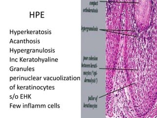 HPE
Hyperkeratosis
Acanthosis
Hypergranulosis
Inc Keratohyaline
Granules
perinuclear vacuolization
of keratinocytes
s/o EHK
Few inflamm cells
 