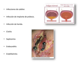 • Infecciones de catéter.
• Infección de implante de prótesis.
• Infección de herida.
• Cistitis
• Septicemia
• Endocarditis
• Endoftalmitis