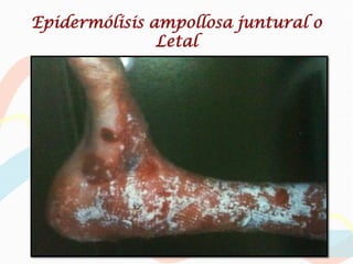 Epidermólisis ampollosa juntural o
               Letal
 
